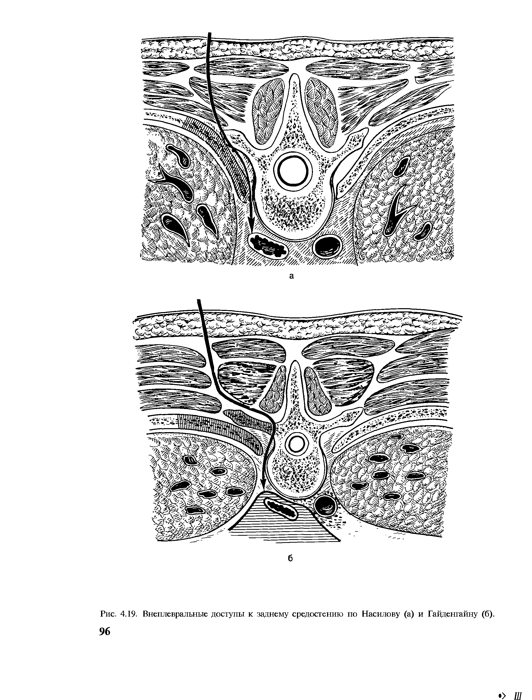 Рис. 4.19. Внеплевральные доступы к заднему средостению по Насилову (а) и Гайденгайну (б).
