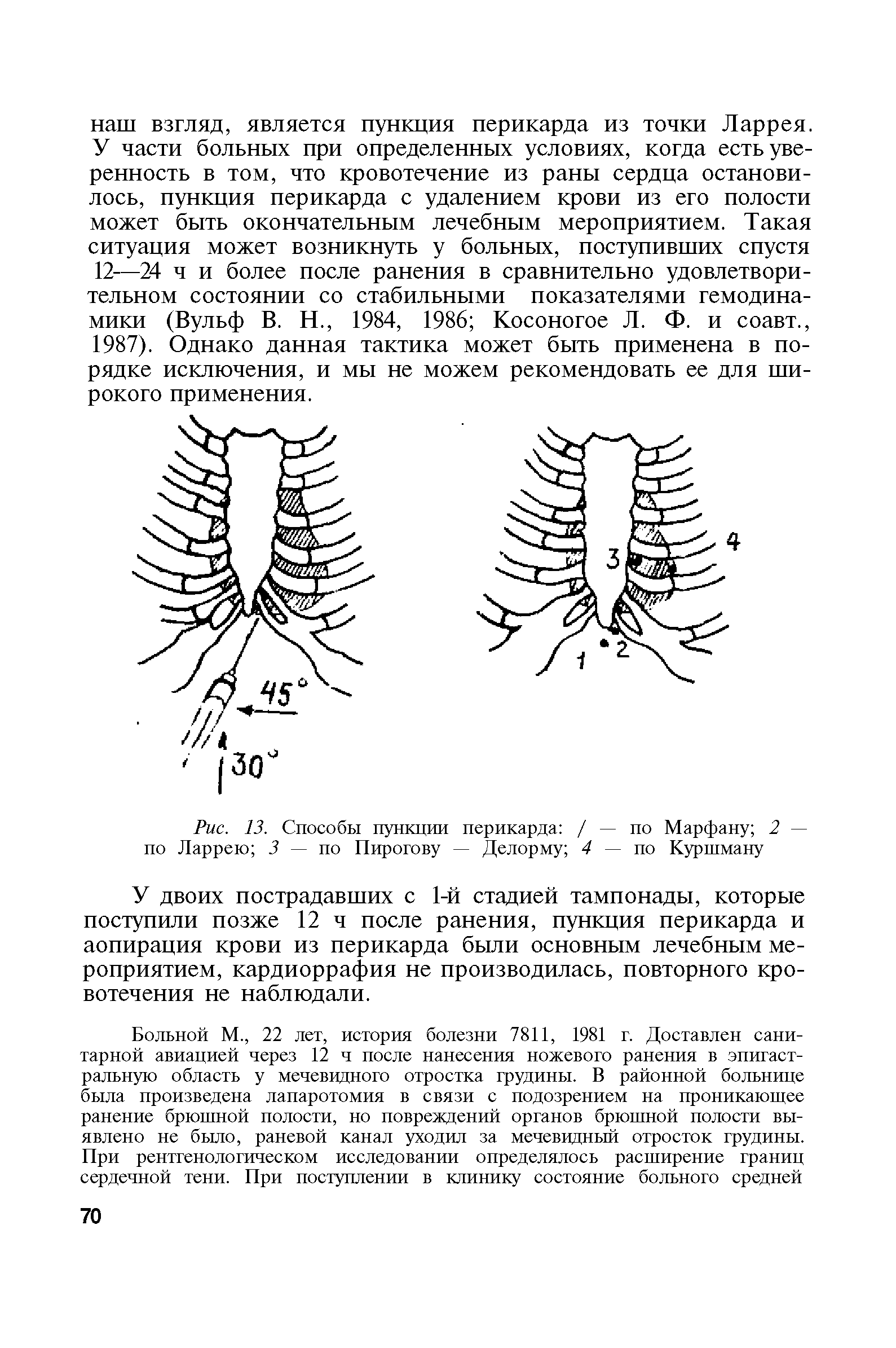 Рис. 13. Способы пункции перикарда / — по Марфану 2 — по Ларрею 3 — по Пирогову — Делорму 4 — по Куршману...