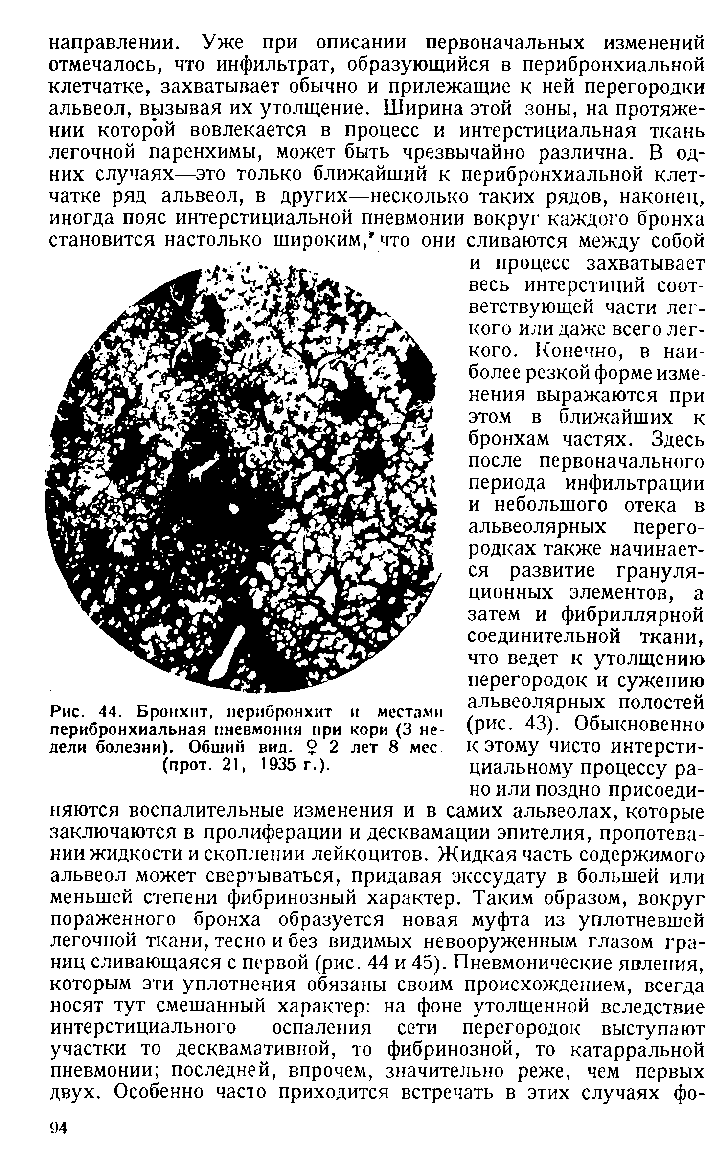 Рис. 44. Бронхит, перибронхит и местами перибронхиальная пневмония при кори (3 недели болезни). Общий вид. 2 лет 8 мес (прот. 21, 1935 г.).