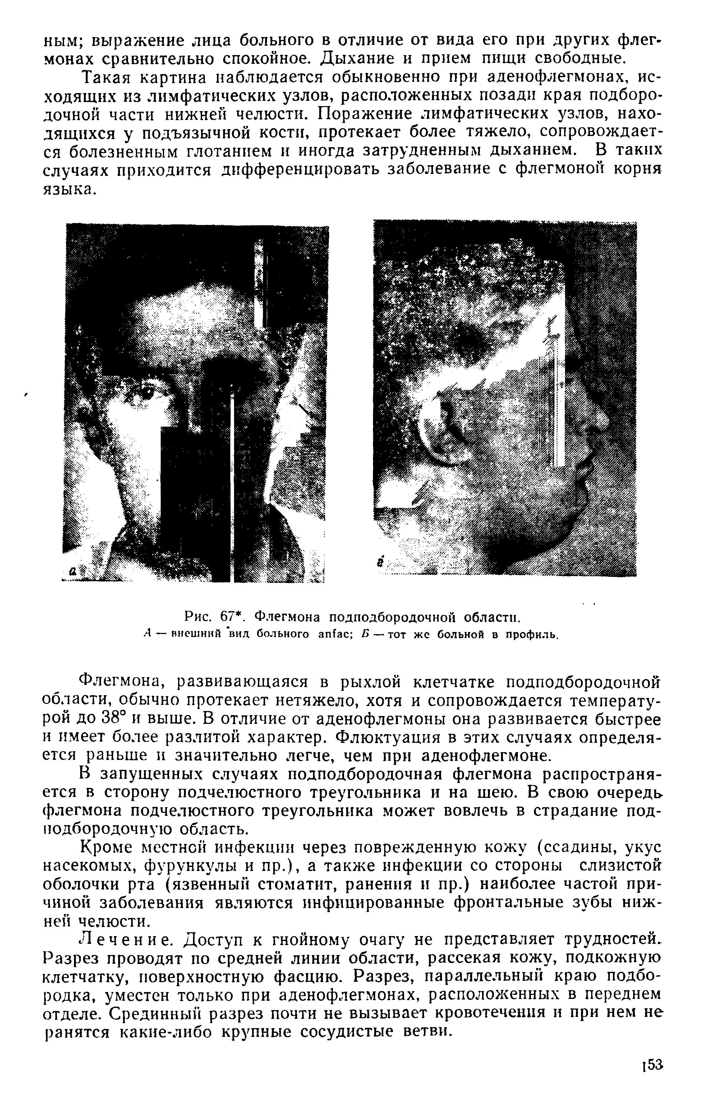 Рис. 67. Флегмона подподбородочной области. Д — внешний вид больного агИас Б — тот же больной в профиль.