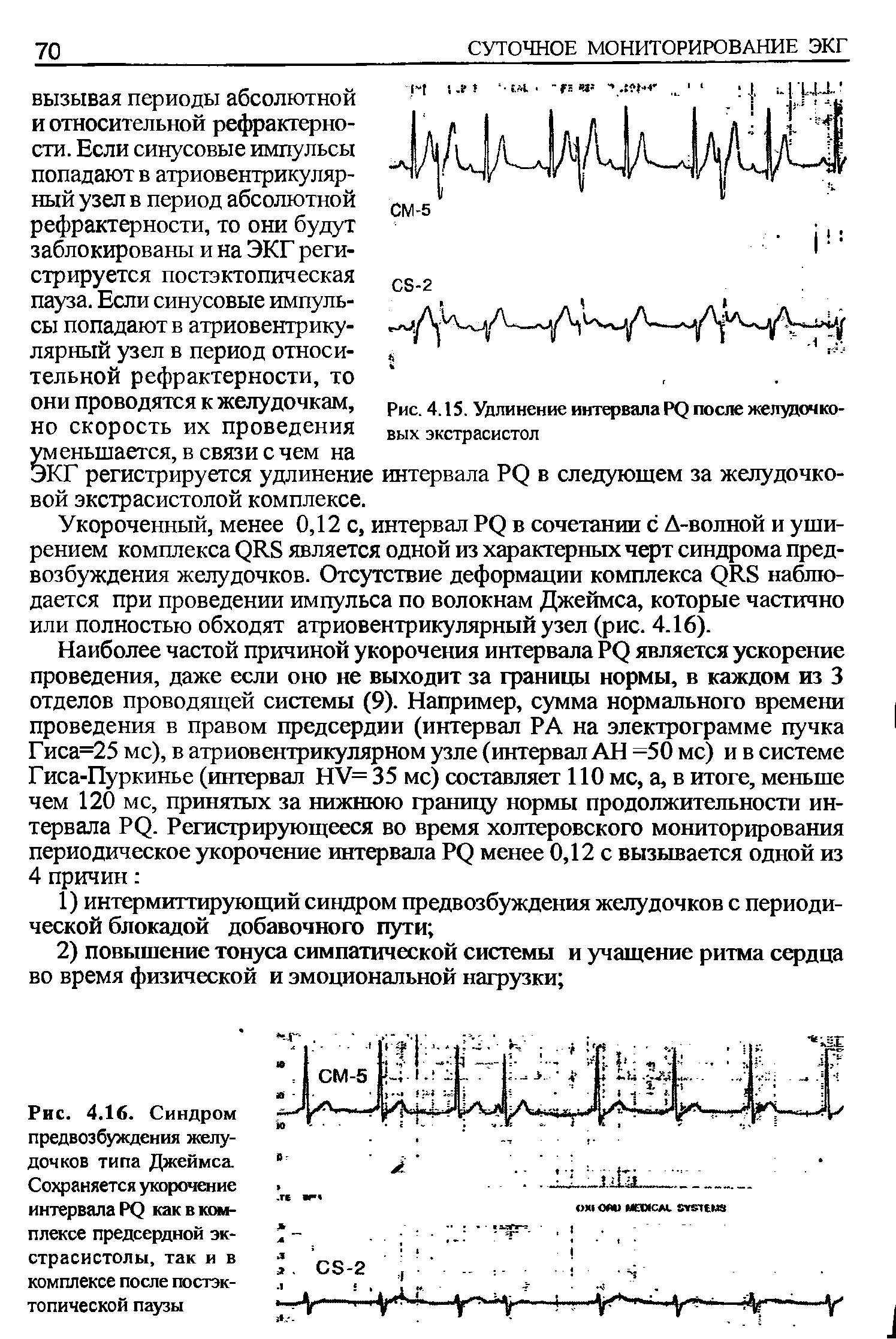 Рис. 4.16. Синдром предвозбуждения желудочков типа Джеймса. Сохраняется укорочение интервала Р< как в комплексе предсердной экстрасистолы, так и в комплексе после постэктопической паузы...