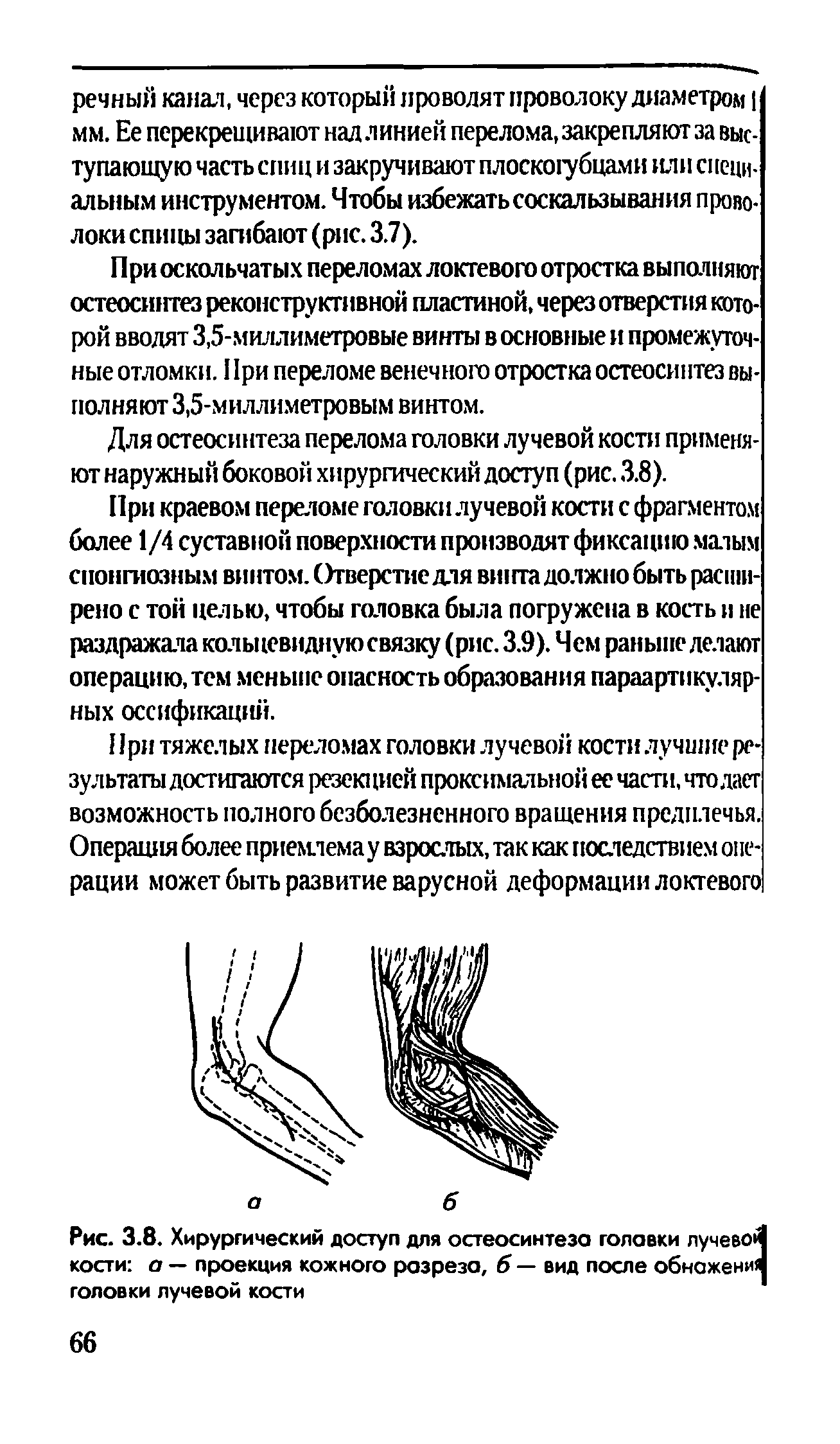 Рис. 3.8. Хирургический доступ для остеосинтеза головки лучево> кости а — проекция кожного разреза, б — вид после обнажени, головки лучевой кости...