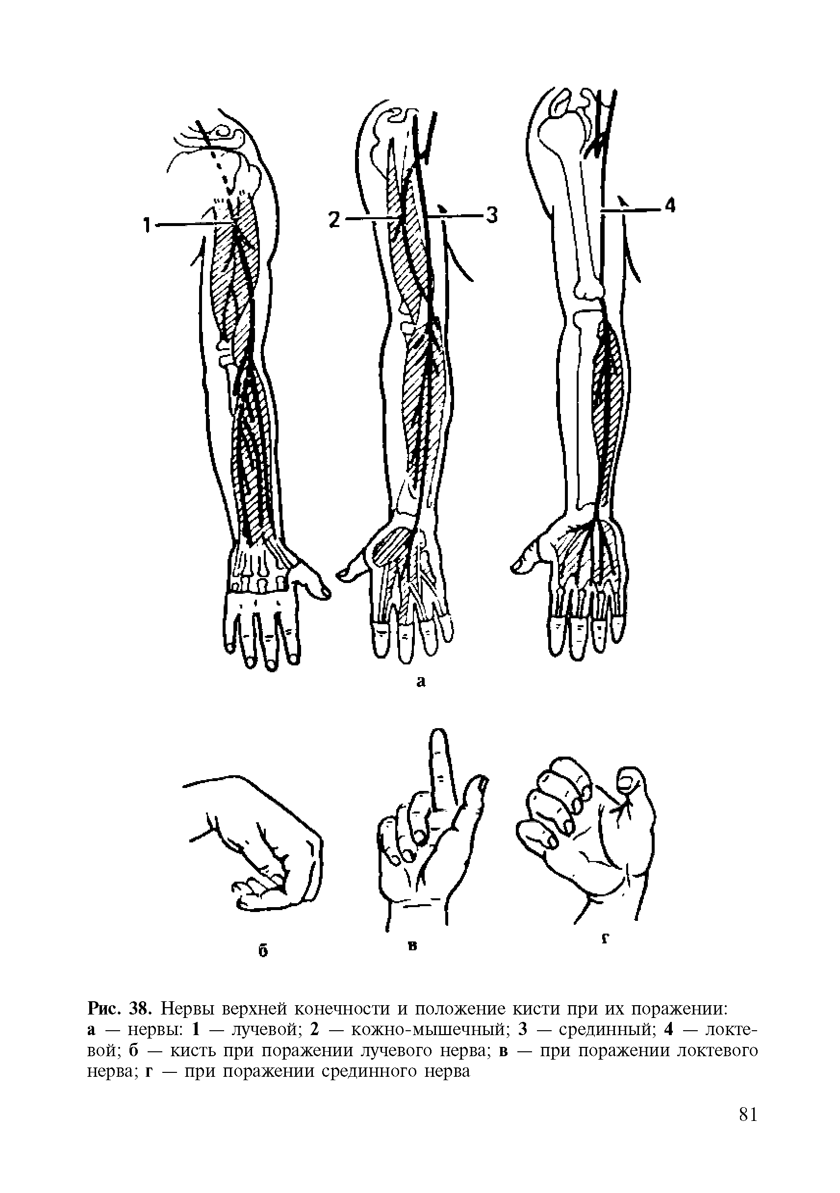 Рис. 38. Нервы верхней конечности и положение кисти при их поражении а — нервы 1 — лучевой 2 — кожно-мышечный 3 — срединный 4 — локтевой б — кисть при поражении лучевого нерва в — при поражении локтевого нерва г — при поражении срединного нерва...