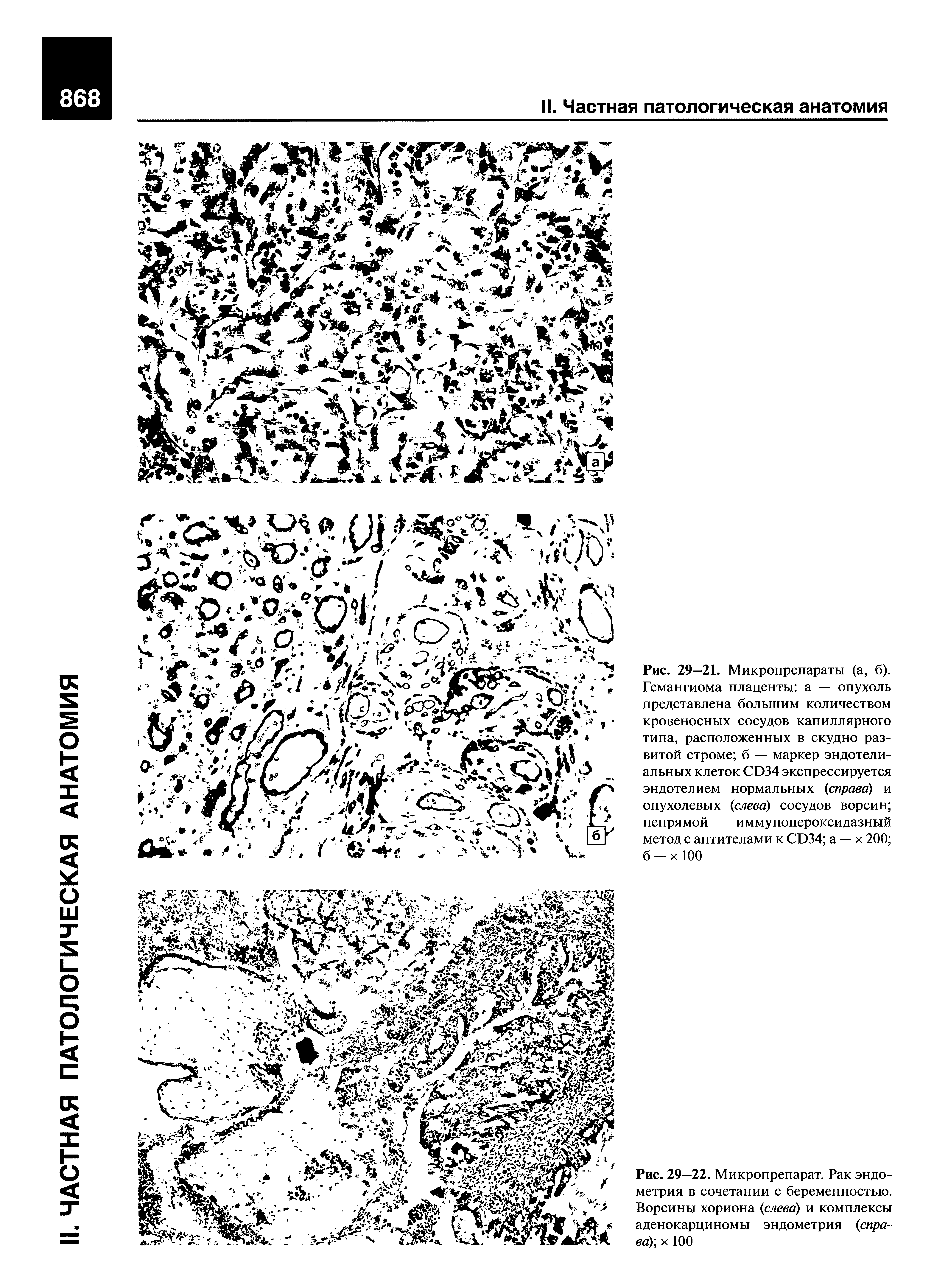 Рис. 29—21. Микропрепараты (а, б). Гемангиома плаценты а — опухоль представлена большим количеством кровеносных сосудов капиллярного типа, расположенных в скудно развитой строме б — маркер эндотелиальных клеток СЭ34 экспрессируется эндотелием нормальных (справа) и опухолевых (слева) сосудов ворсин непрямой иммунопероксидазный метод с антителами к СБ34 а — х 200 б - х 100...