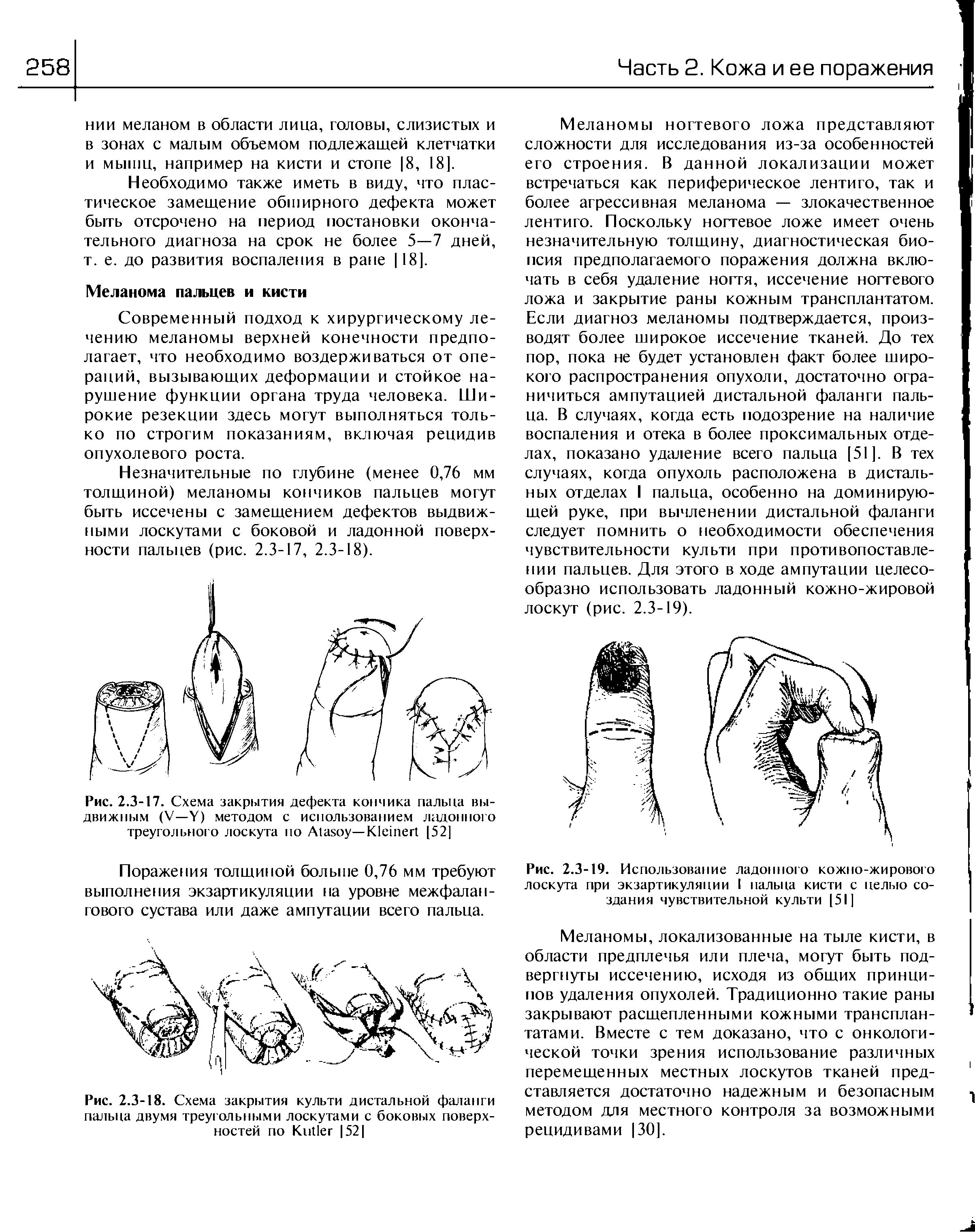 Рис. 2.3-19. Использование ладонного кожно-жирового лоскута при экзартикуляции I пальца кисти с целью создания чувствительной культи [51]...