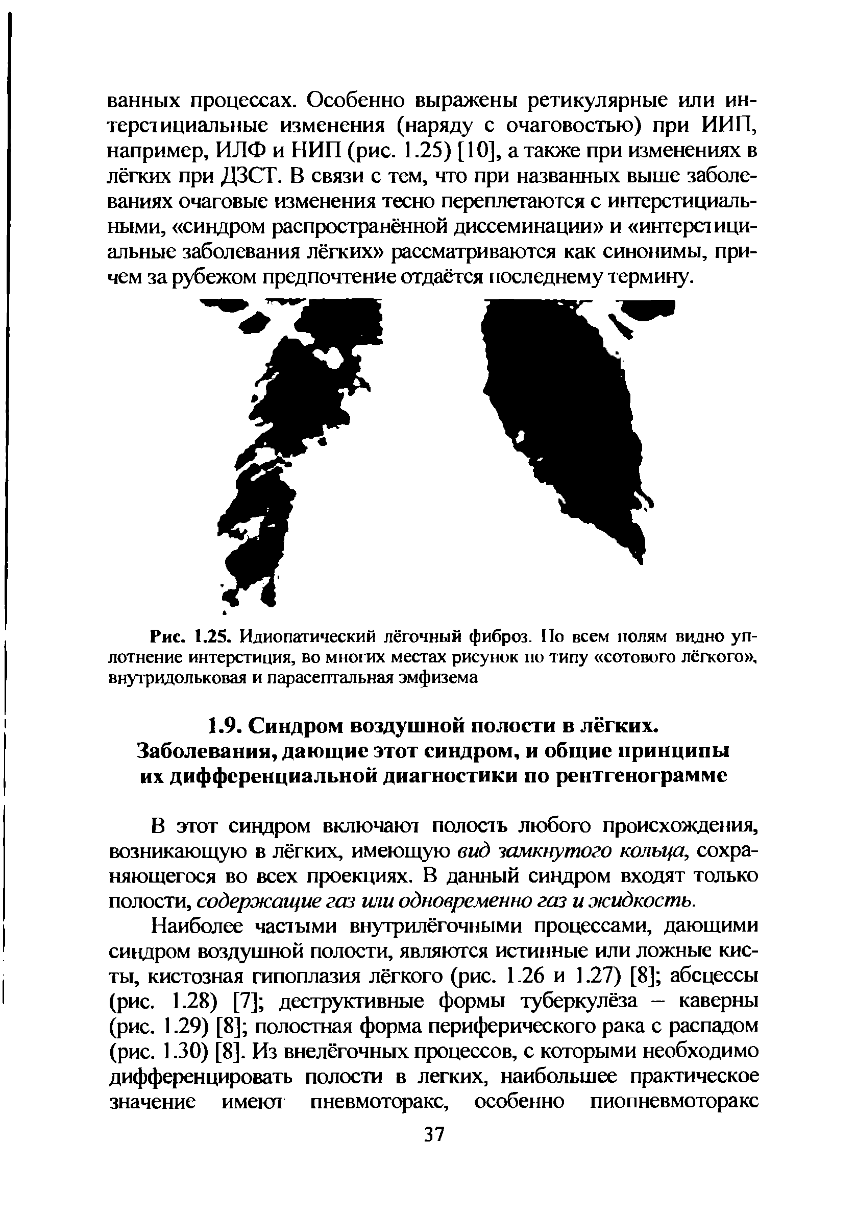 Рис. 1.25. Идиопатический лёгочный фиброз. По всем полям видно уплотнение интерстиция, во многих местах рисунок по типу сотового лёгкого , внутридольковая и парасептальная эмфизема...