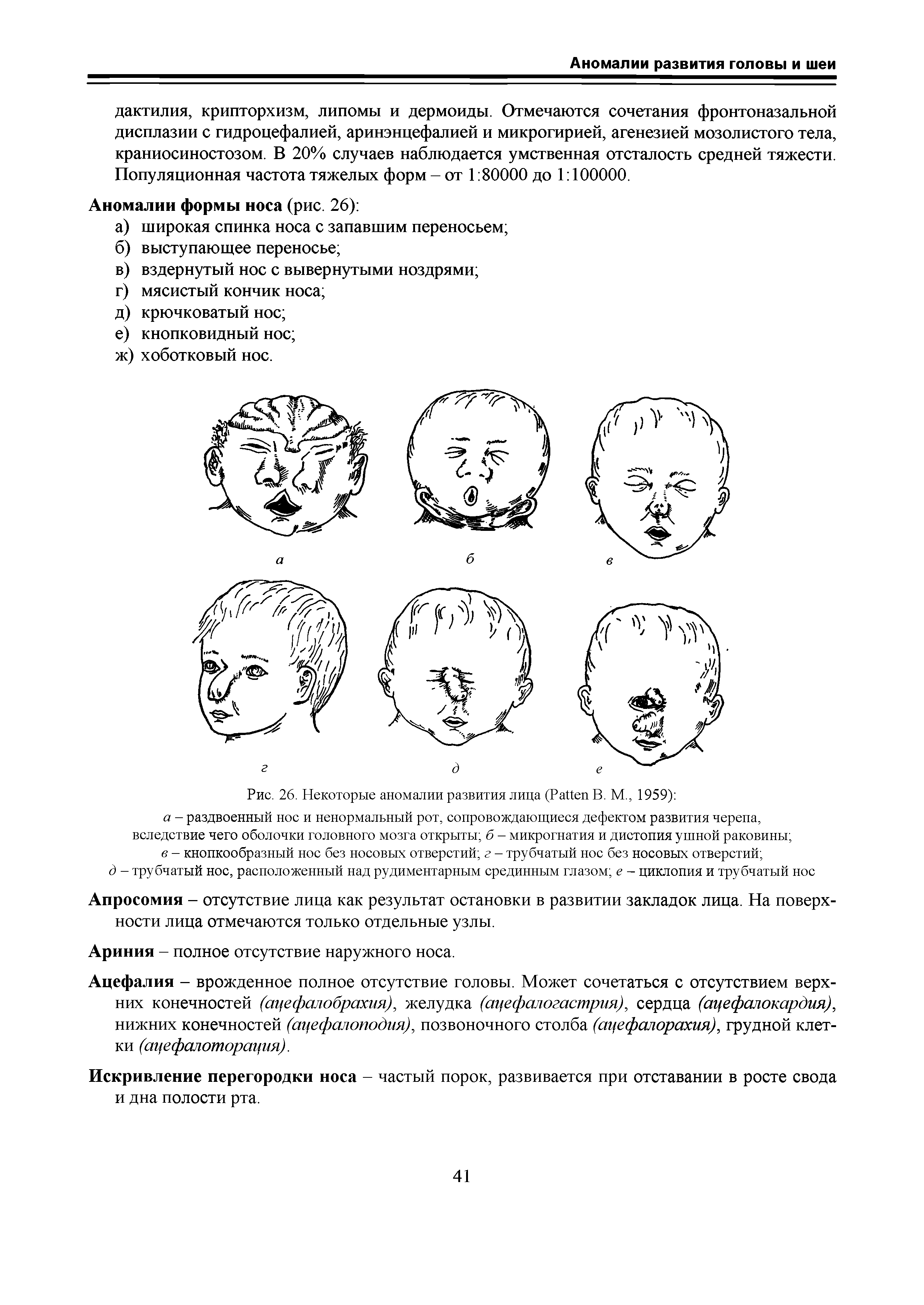 Рис. 26. Некоторые аномалии развития лица (P В. М., 1959) а - раздвоенный нос и ненормальный рот, сопровождающиеся дефектом развития черепа, вследствие чего оболочки головного мозга открыты б - микрогнатия и дистопия ушной раковины в - кнопкообразный нос без носовых отверстий г - трубчатый нос без носовых отверстий ...