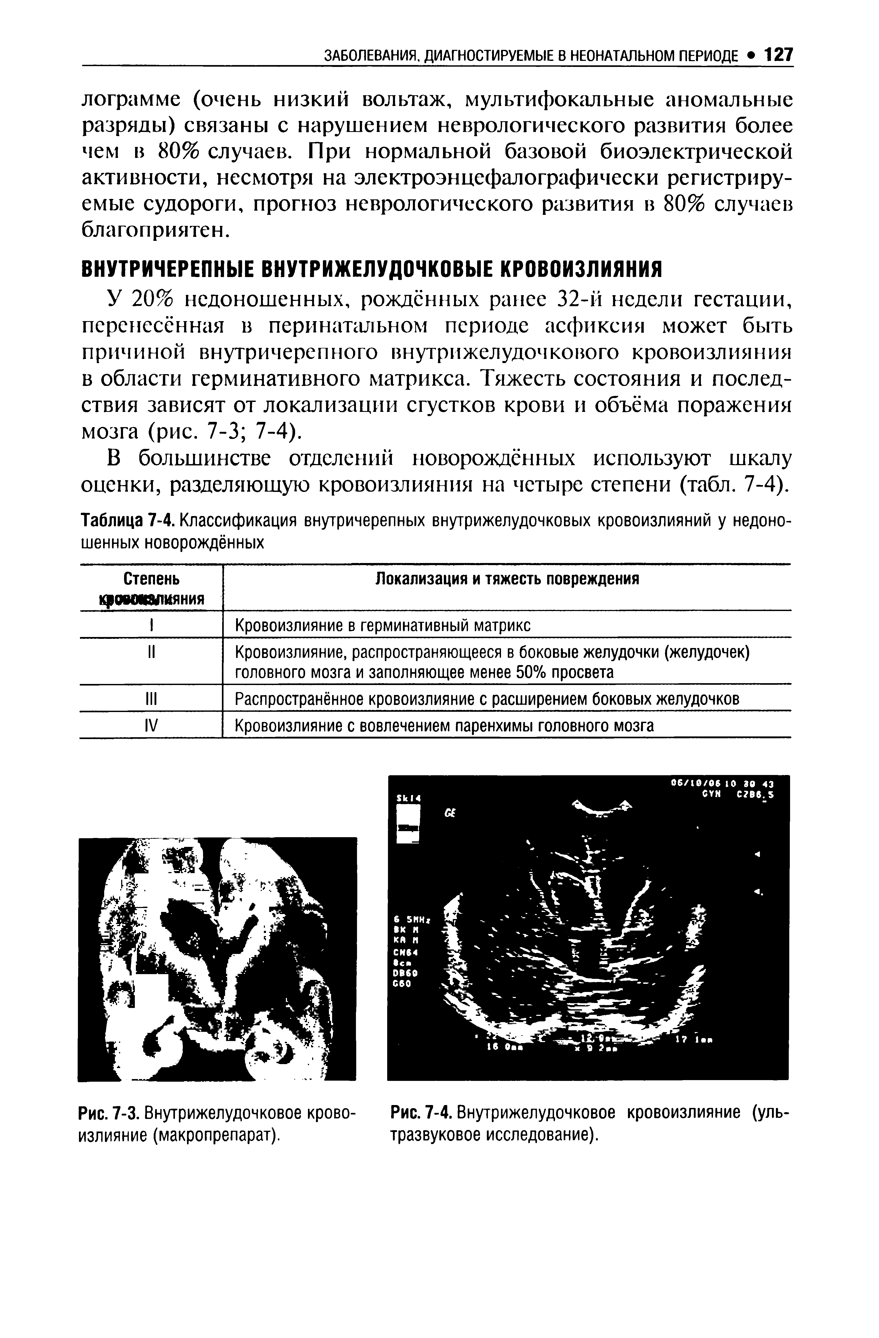 Таблица 7-4. Классификация внутричерепных внутрижелудочковых кровоизлияний у недоношенных новорождённых...