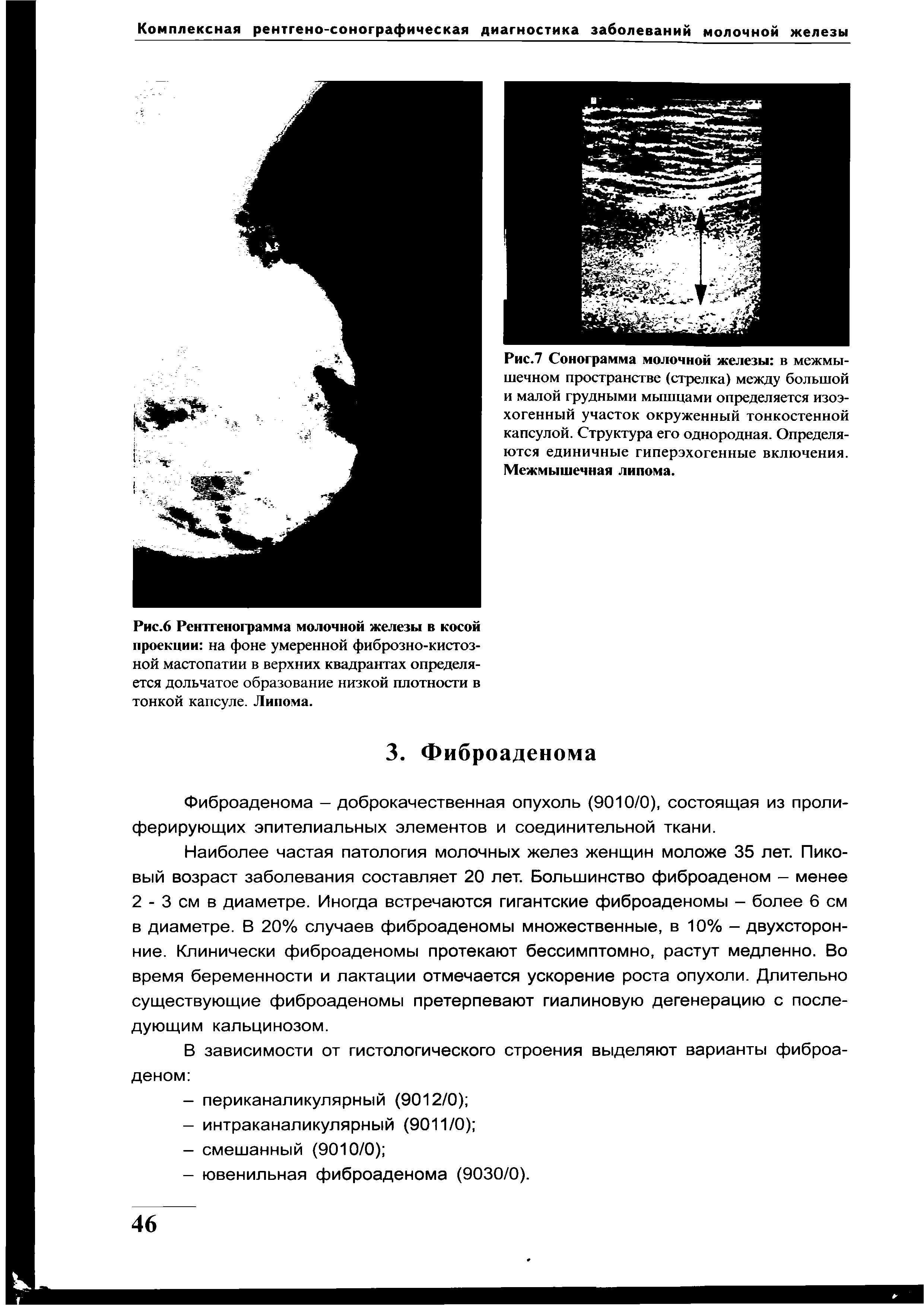 Рис.7 Сонограмма молочной железы в межмышечном пространстве (стрелка) между большой и малой грудными мышцами определяется изоэ-хогенный участок окруженный тонкостенной капсулой. Структура его однородная. Определяются единичные гиперэхогенные включения. Межмышечная липома.