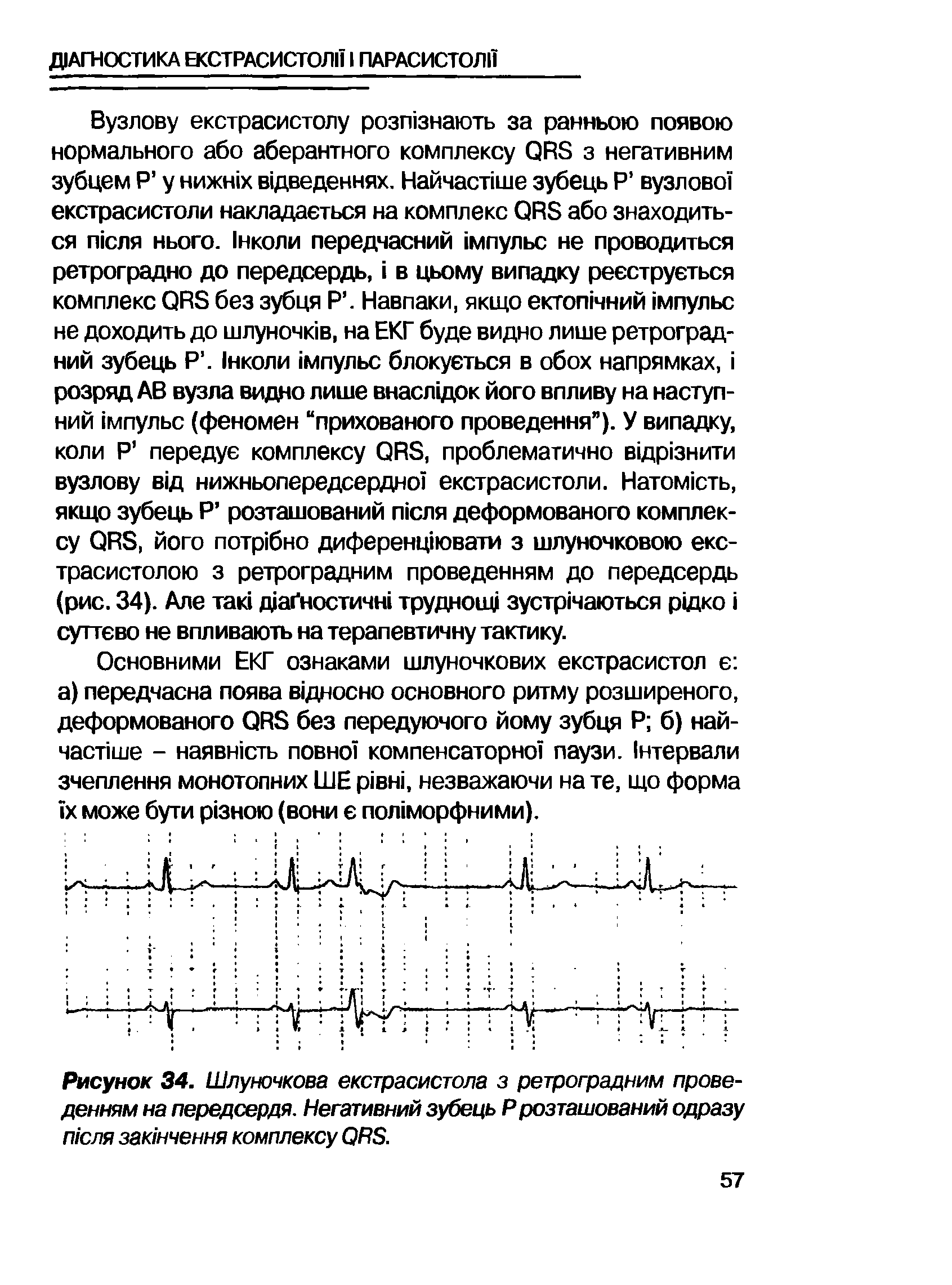 Рисунок 34. Шлуночкова екстрасистола з ретроградним проведениям на передсердя. Негативний зубець Р розташований одразу пюля заюнчення комплексу ОРБ.