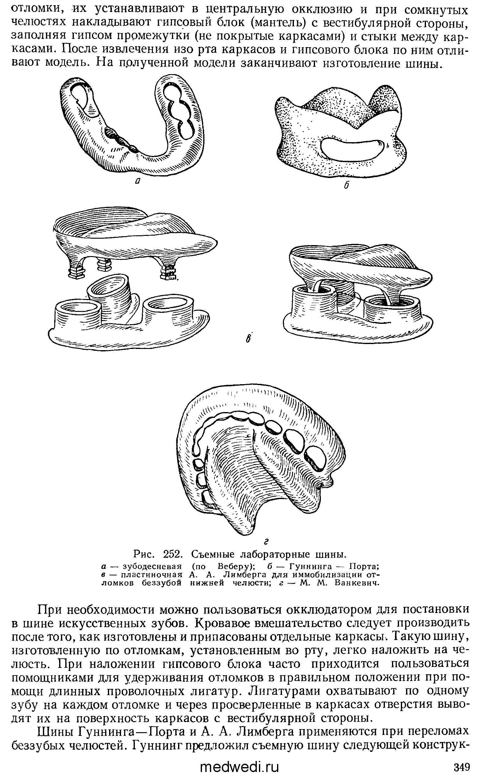 Рис. 252. Съемные лабораторные шины. а — зубодесневая (по Веберу) б — Гуннинга — Порта в — пластиночная А. А. Лимберга для иммобилизации отломков беззубой нижней челюсти г — М. М. Ванкевич.