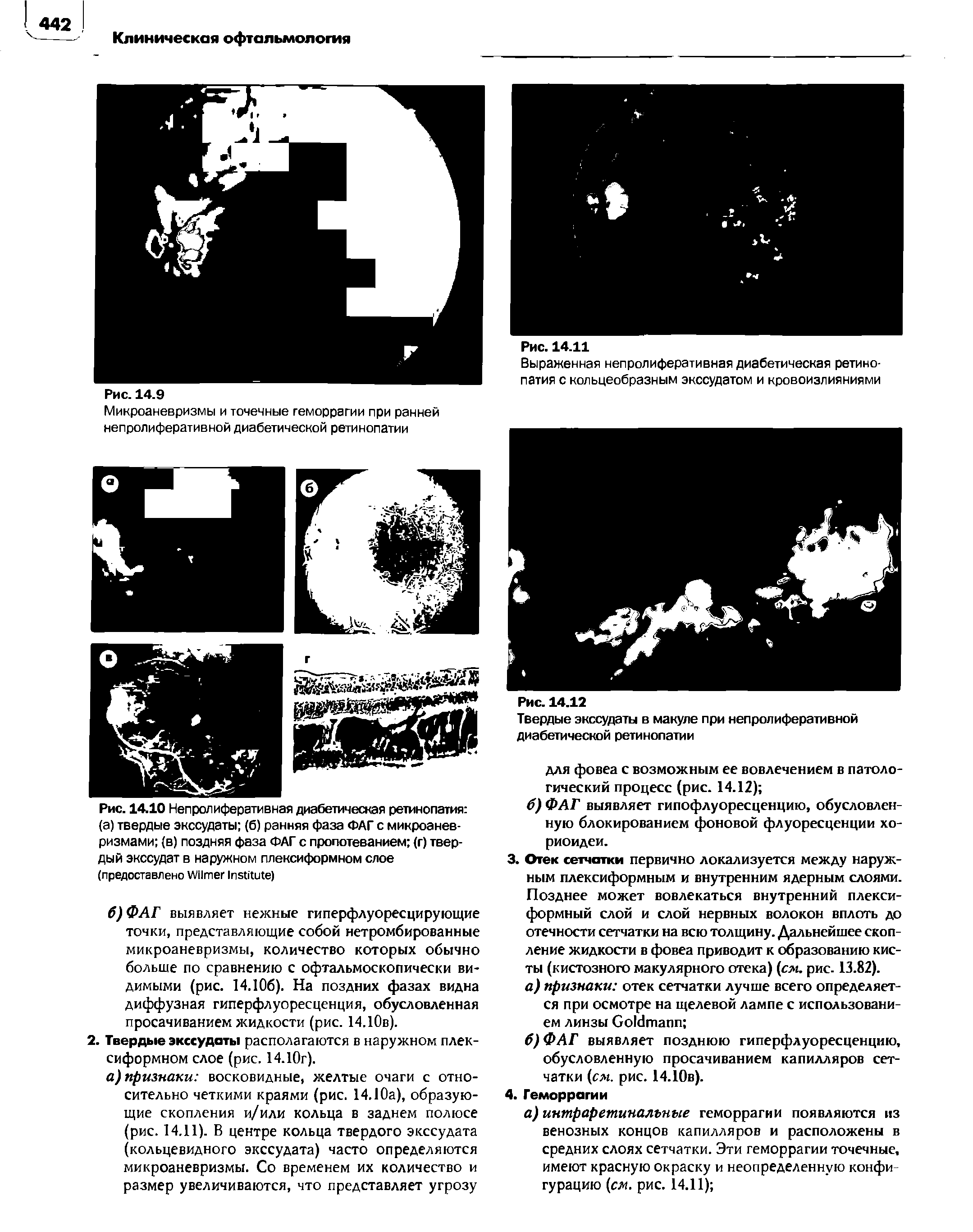 Рис. 14.10 Непролиферативная диабетическая ретинопатия (а) твердые экссудаты (б) ранняя фаза ФАГ с микроаневризмами (в) поздняя фаза ФАГ с пропотеванием (г) твердый экссудат в наружном плексиформном слое (предоставлено W I )...