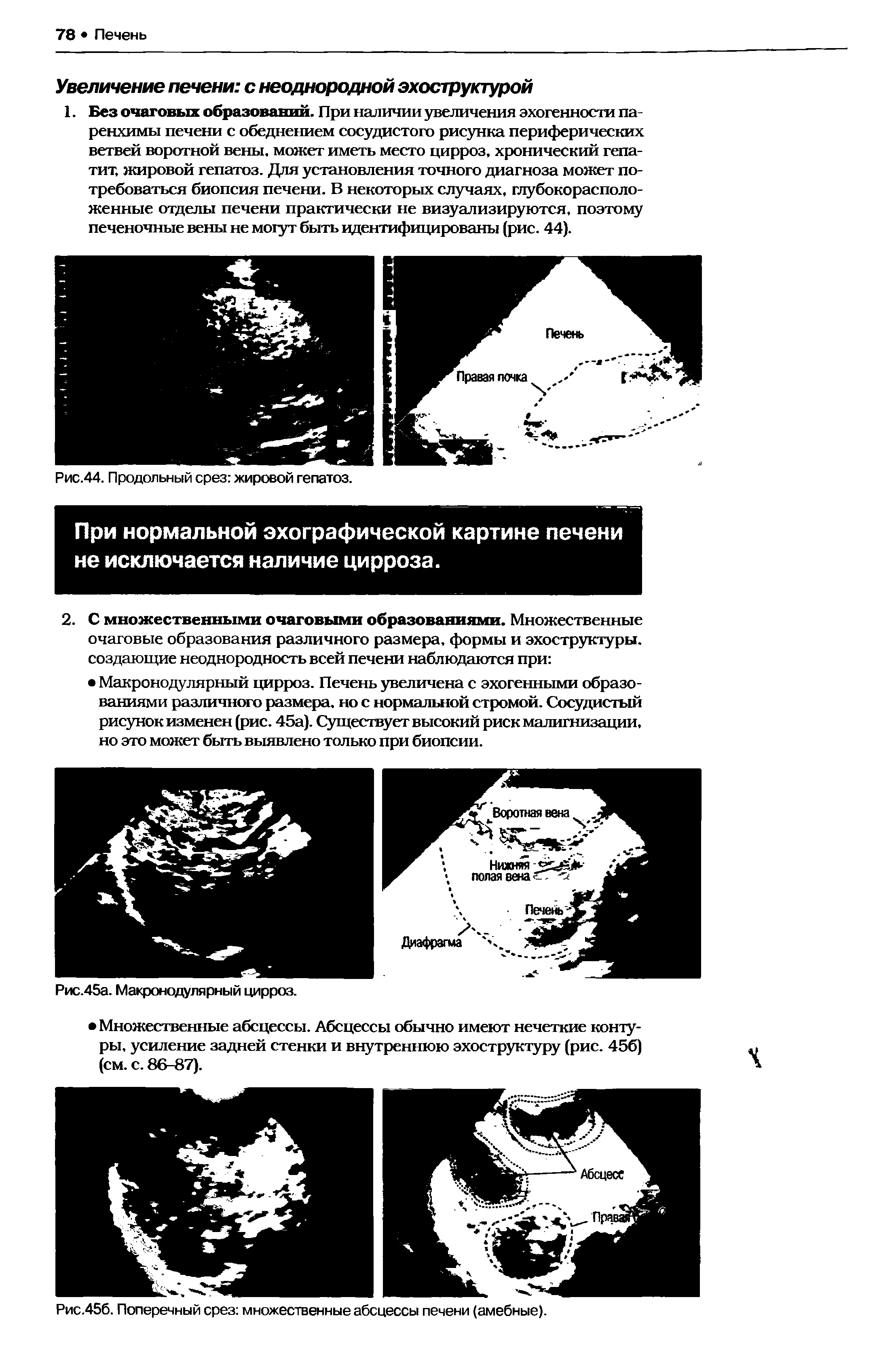 Рис.456. Поперечный срез множественные абсцессы печени (амебные).