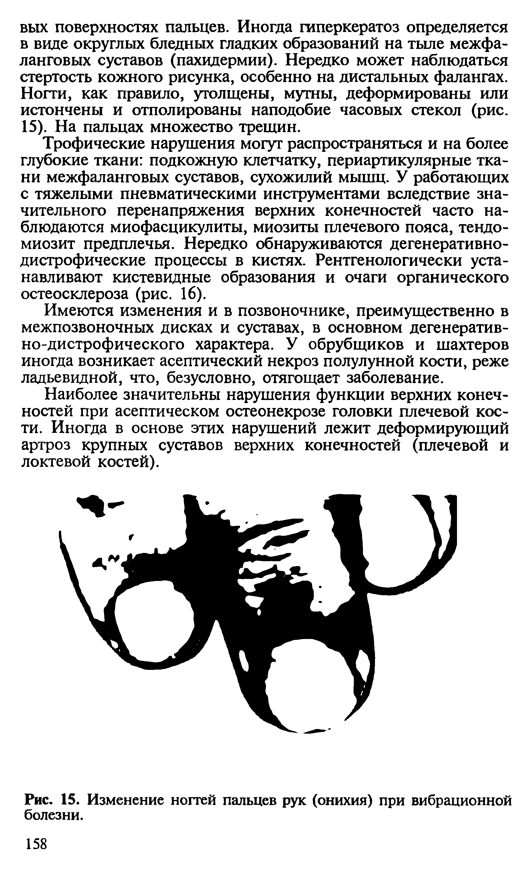 Рис. 15. Изменение ногтей пальцев рук (онихия) при вибрационной болезни.