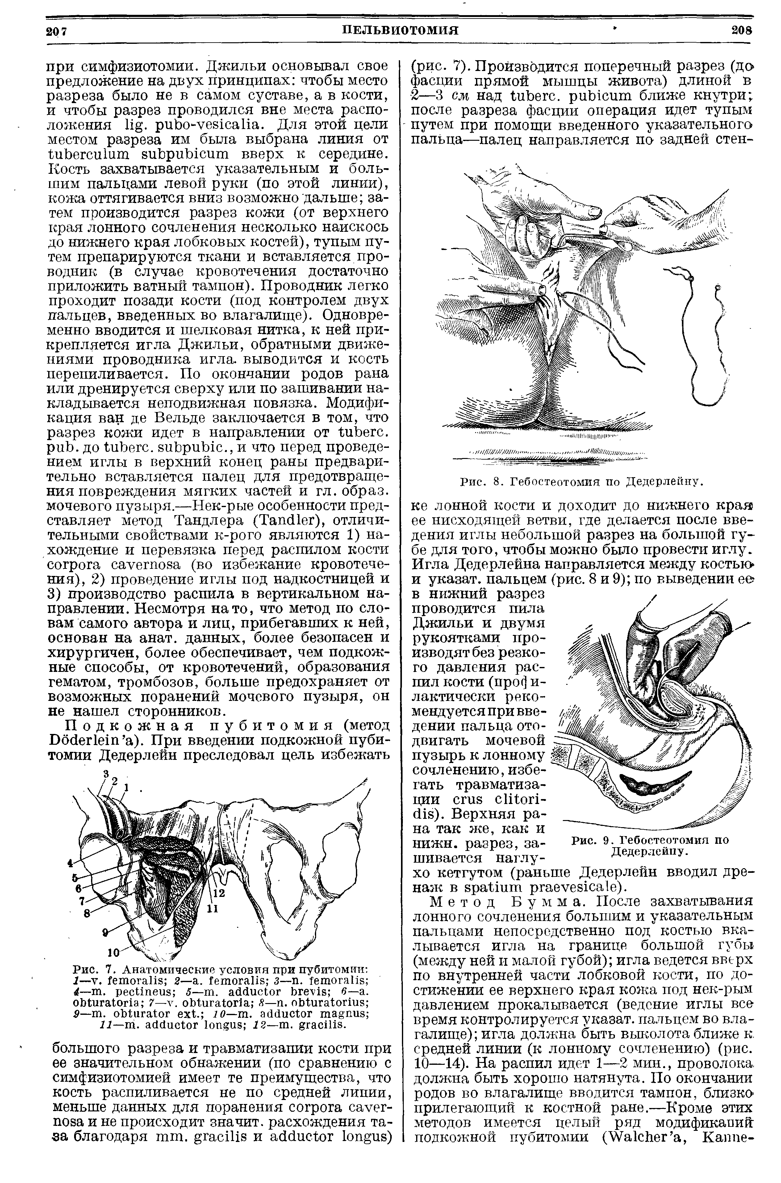 Рис. 7. Анатомические условия при пубитомии 1—V. 2—а. 3— . 4— . 5— . в— . 7— . 3— . 9— . . 10— . 11— . 12— . .