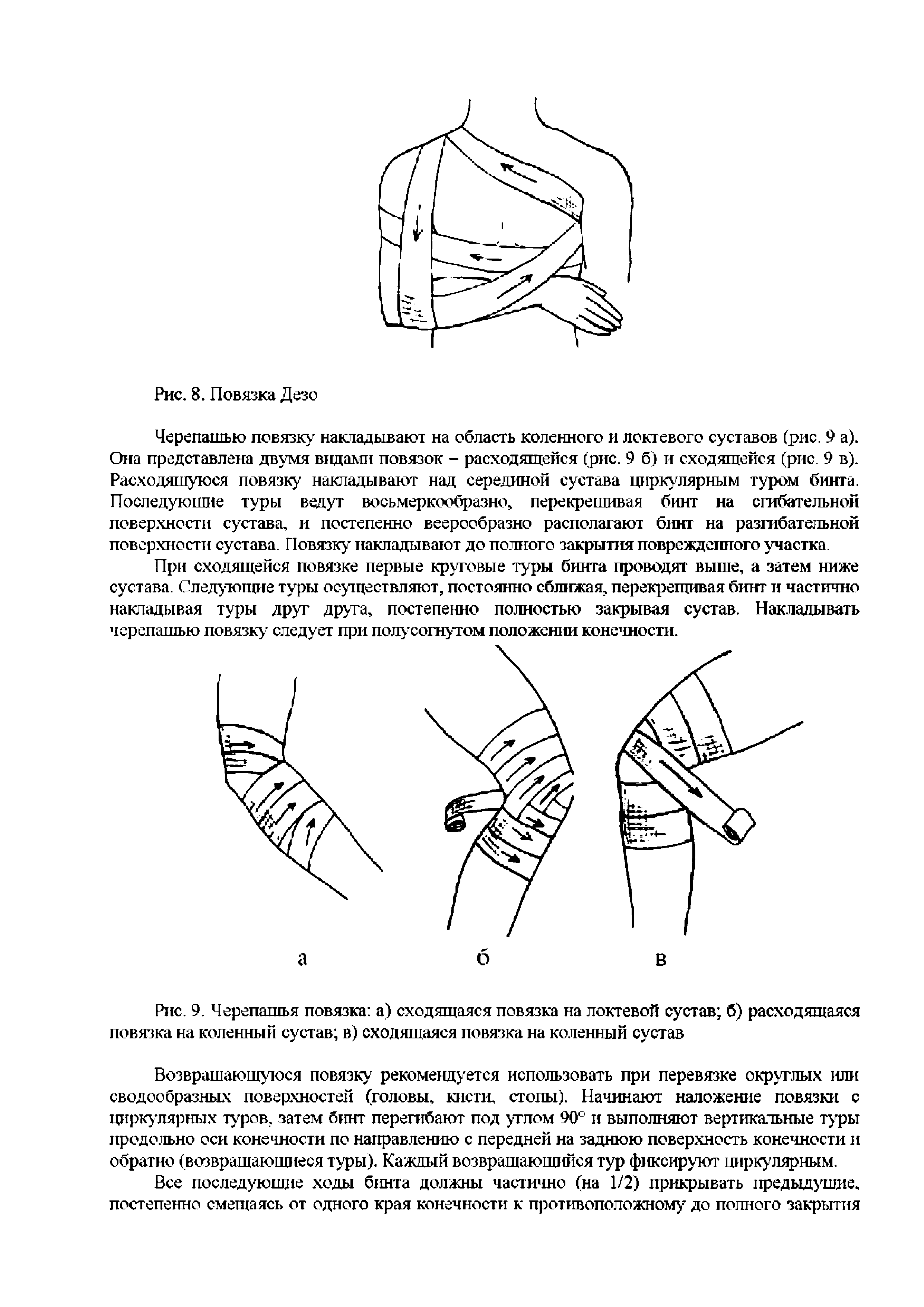 Рис. 9. Черепашья повязка а) сходящаяся повязка на локтевой сустав б) расходящаяся повязка на коленный сустав в) сходящаяся повязка на коленный сустав...