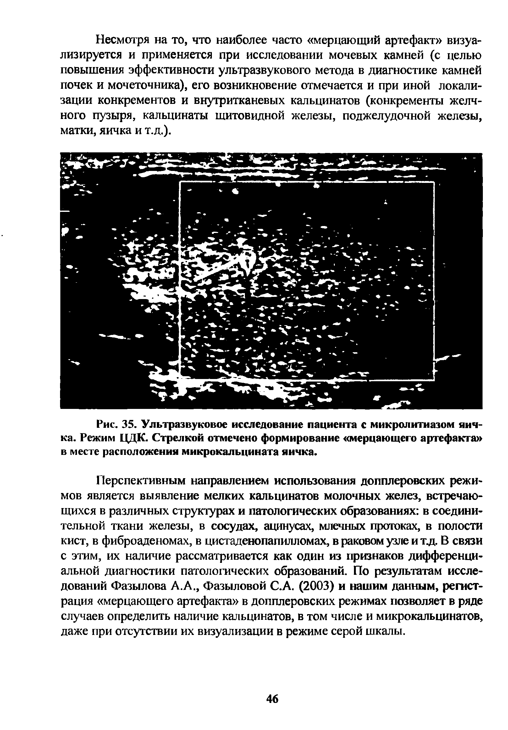 Рис. 35. Ультразвуковое исследование пациента с микролитиазом яичка. Режим ЦДК. Стрелкой отмечено формирование мерцающего артефакта ...