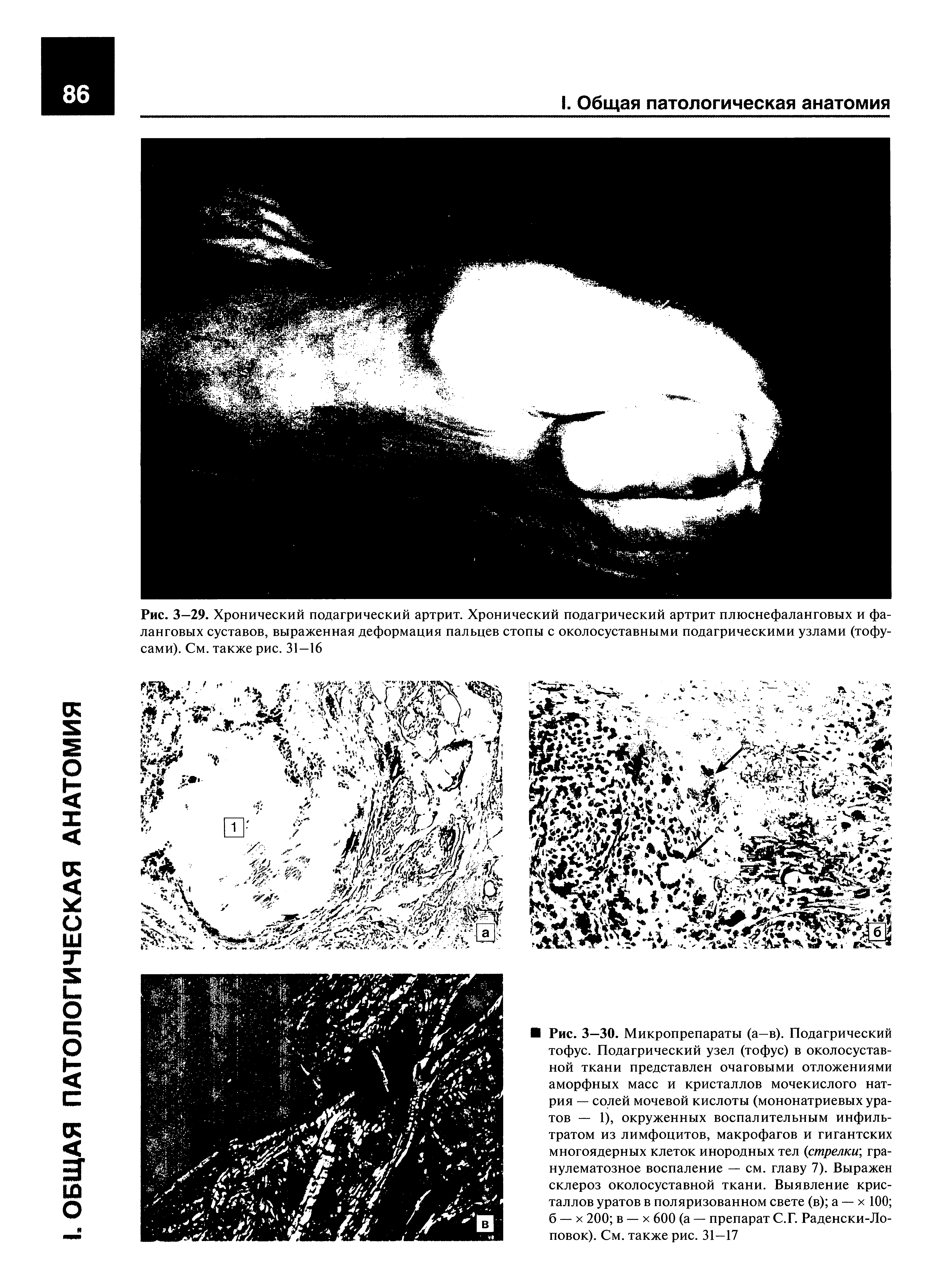 Рис. 3—29. Хронический подагрический артрит. Хронический подагрический артрит плюснефаланговых и фаланговых суставов, выраженная деформация пальцев стопы с околосуставными подагрическими узлами (тофу-сами). См. также рис. 31—16...