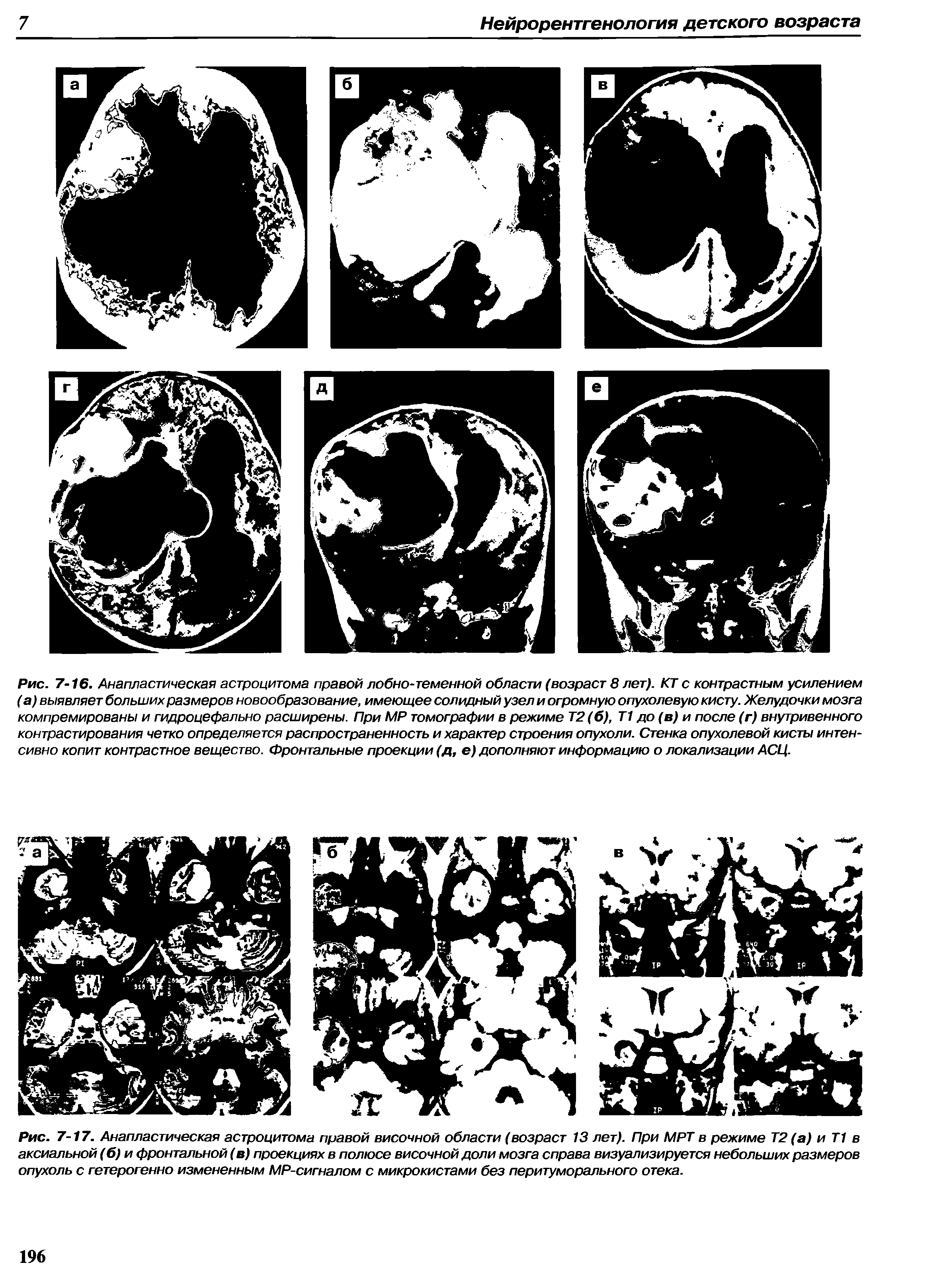 Рис. 7-17. Анапластическая астроцитома правой височной области (возраст 13 лет). При МРТ в режиме Т2 (а) и Т1 в аксиальной (б) и фронтальной (в) проекциях в полюсе височной доли мозга справа визуализируется небольших размеров опухоль с гетерогенно измененным MP-сигналом с микрокистами без перитуморального отека.