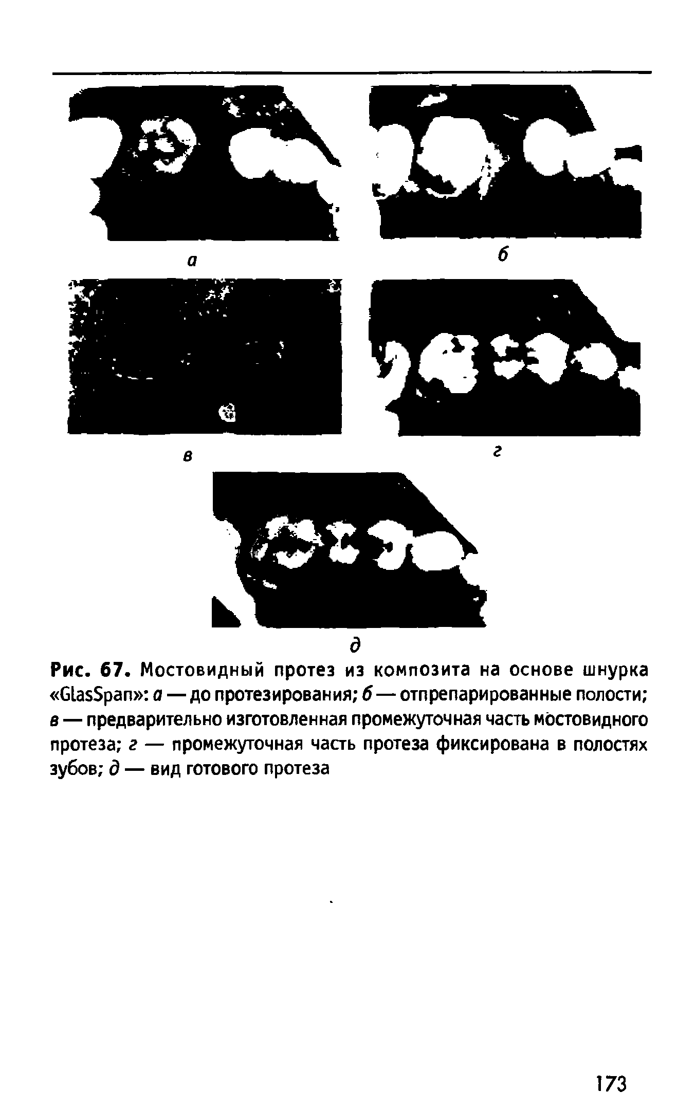 Рис. 67. Мостовидный протез из композита на основе шнурка азБрап а — до протезирования б—отпрепарированные полости в — предварительно изготовленная промежуточная часть мостовидного протеза г — промежуточная часть протеза фиксирована в полостях зубов д — вид готового протеза...