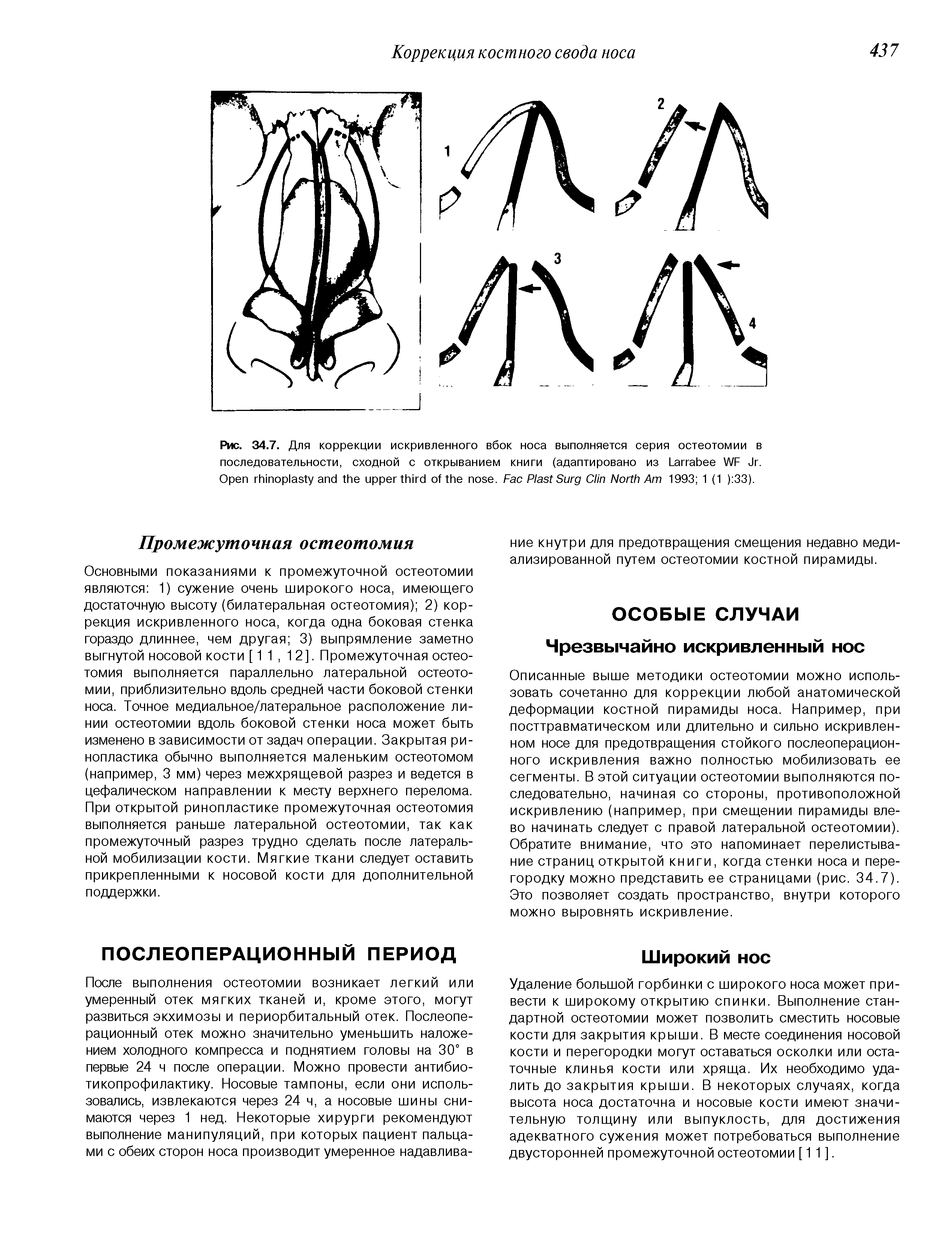 Рис. 34.7. Для коррекции искривленного вбок носа выполняется серия остеотомии в последовательности, сходной с открыванием книги (адаптировано из L WF J . O . F P S C N A 1993 1 (1 ) 33).