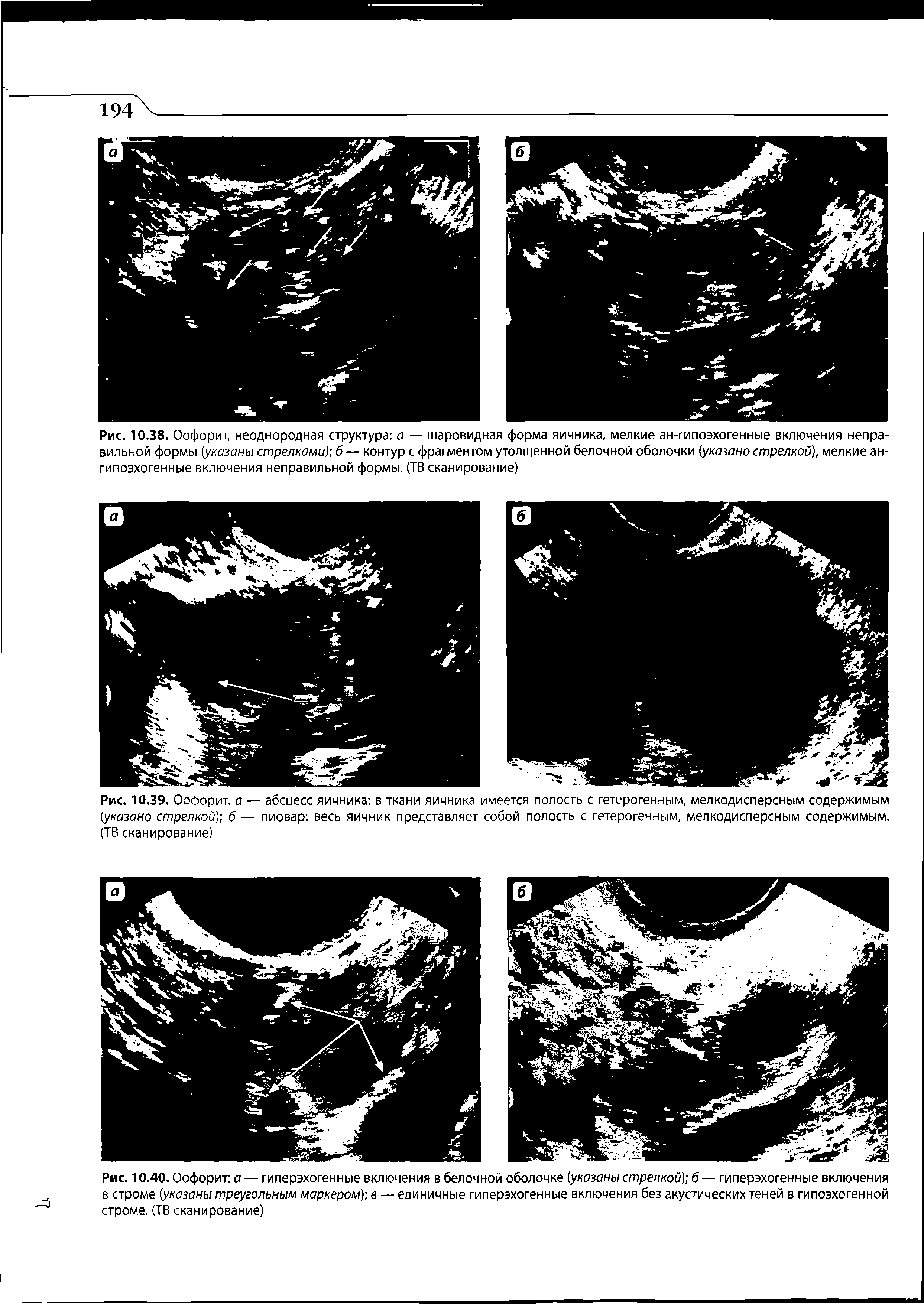 Рис. 10.39. Оофорит, а — абсцесс яичника в ткани яичника имеется полость с гетерогенным, мелкодисперсным содержимым (указано стрелкой) б — пиовар весь яичник представляет собой полость с гетерогенным, мелкодисперсным содержимым. (ТВ сканирование)...