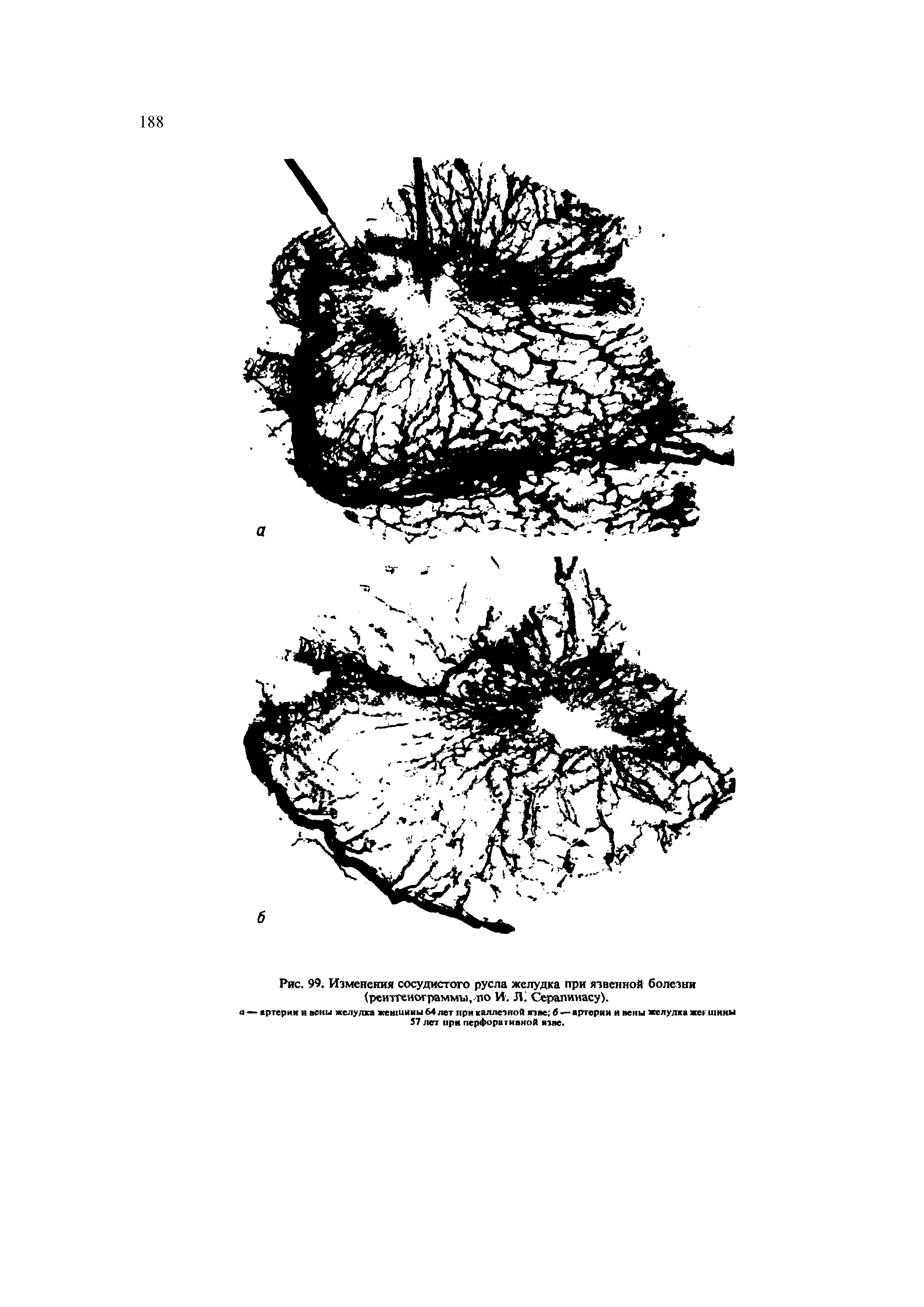 Рис. 99. Изменения сосудистого русла желудка при язвенной болезни (рентгенограммы,.по И. Л. Серапинасу).