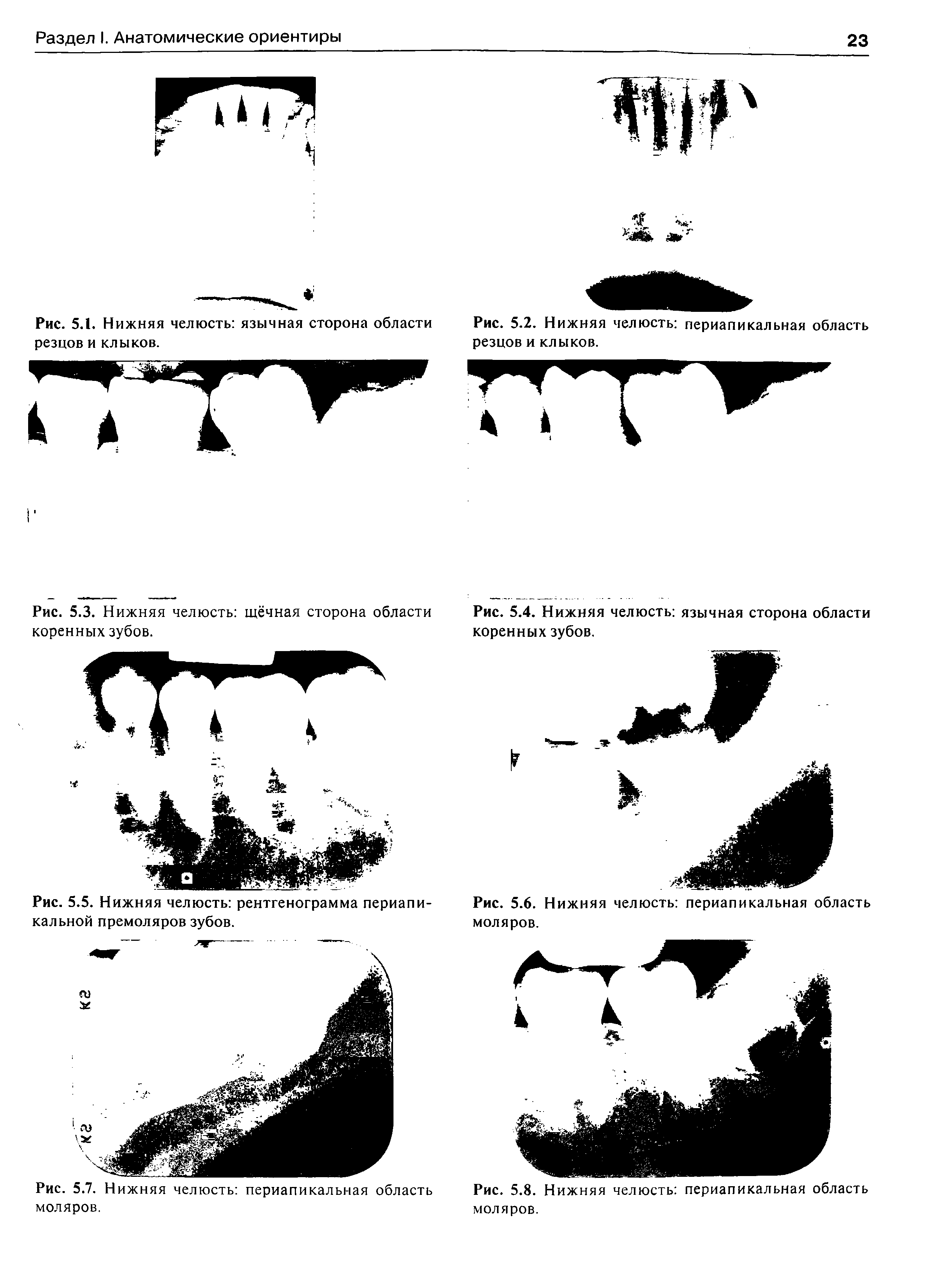 Рис. 5.3. Нижняя челюсть щёчная сторона области коренных зубов.