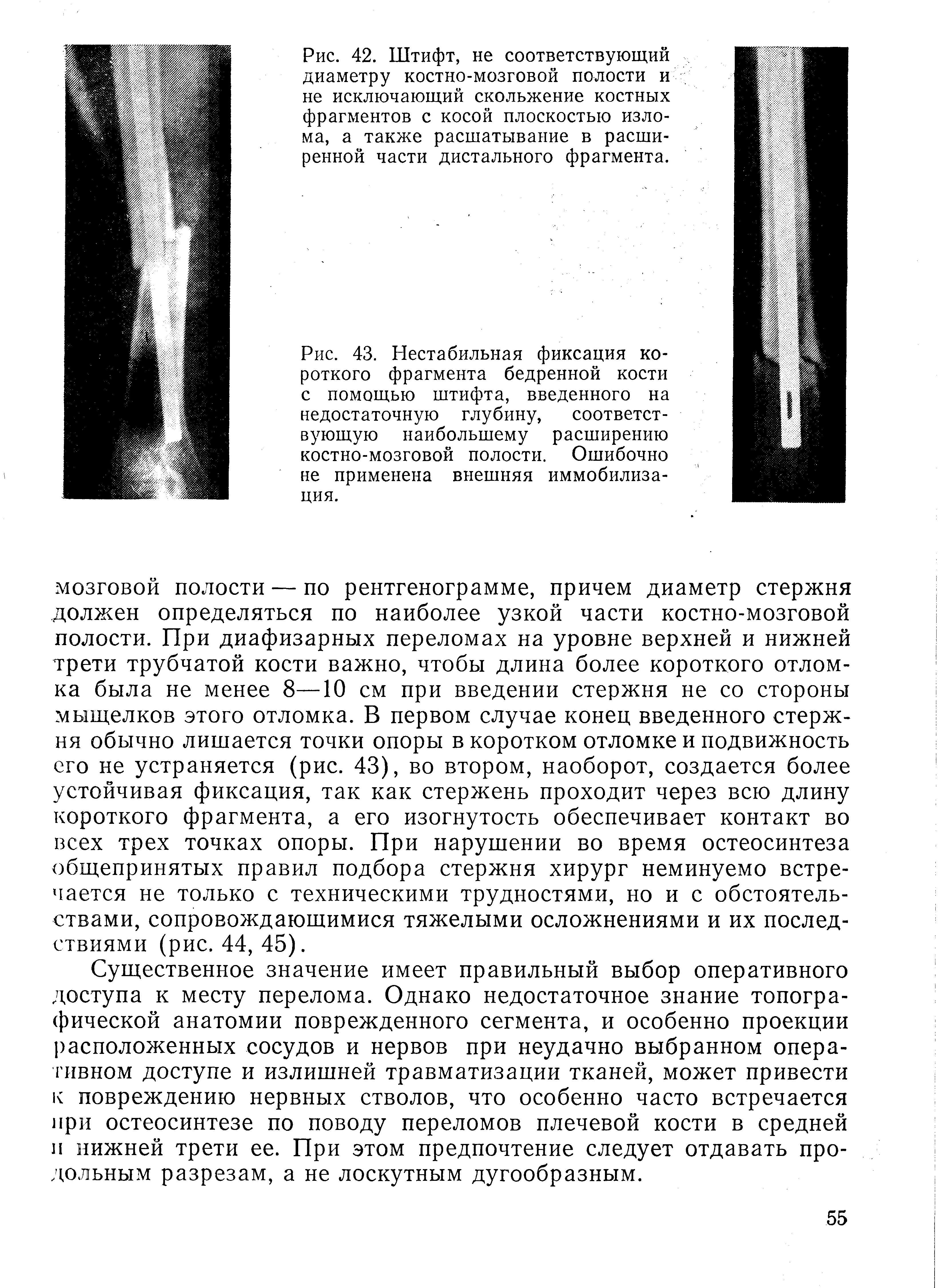 Рис. 43. Нестабильная фиксация короткого фрагмента бедренной кости с помощью штифта, введенного на недостаточную глубину, соответствующую наибольшему расширению костно-мозговой полости. Ошибочно не применена внешняя иммобилизация.