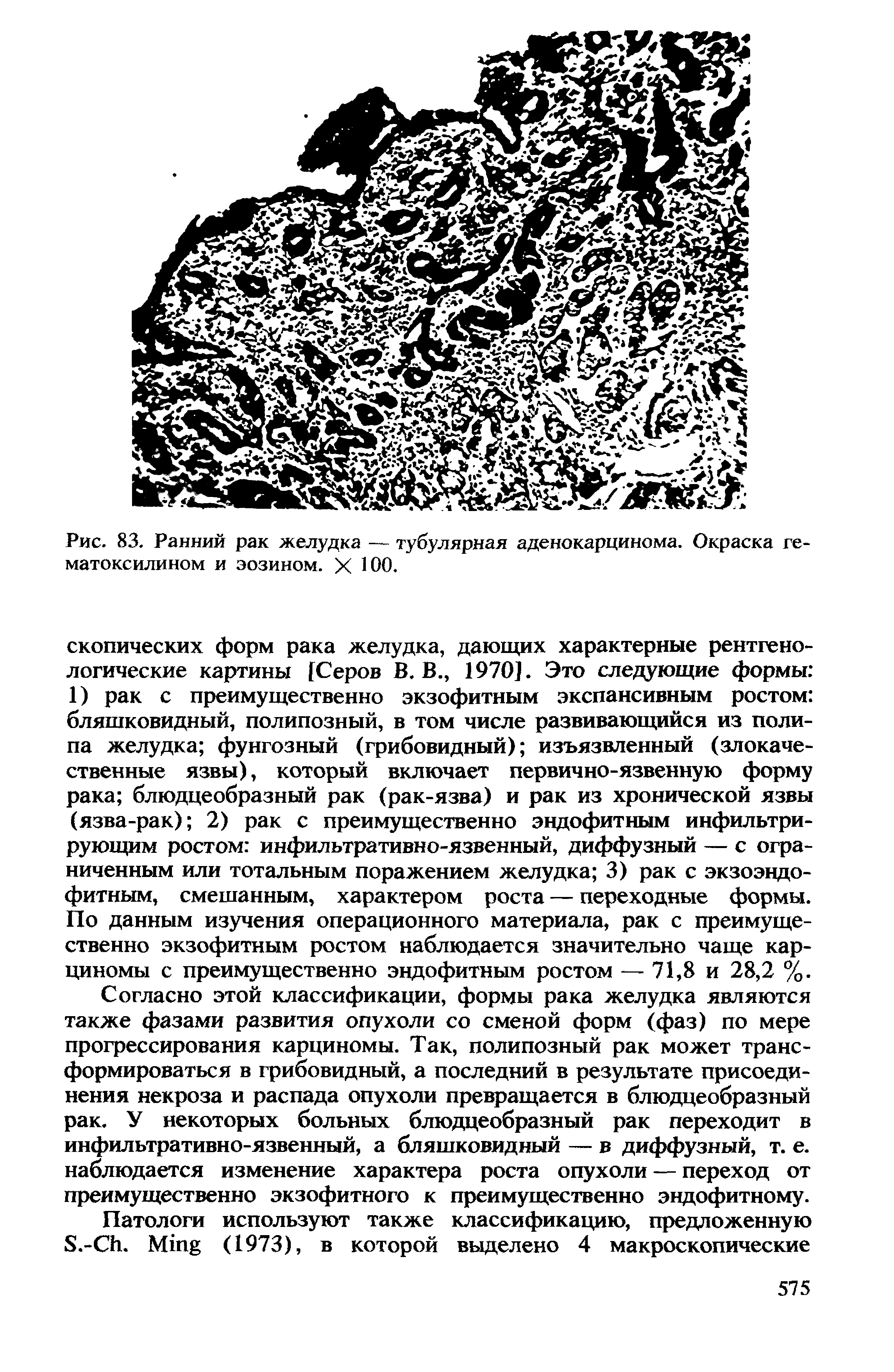 Рис. 83. Ранний рак желудка — тубулярная аденокарцинома. Окраска гематоксилином и эозином. X ЮО.