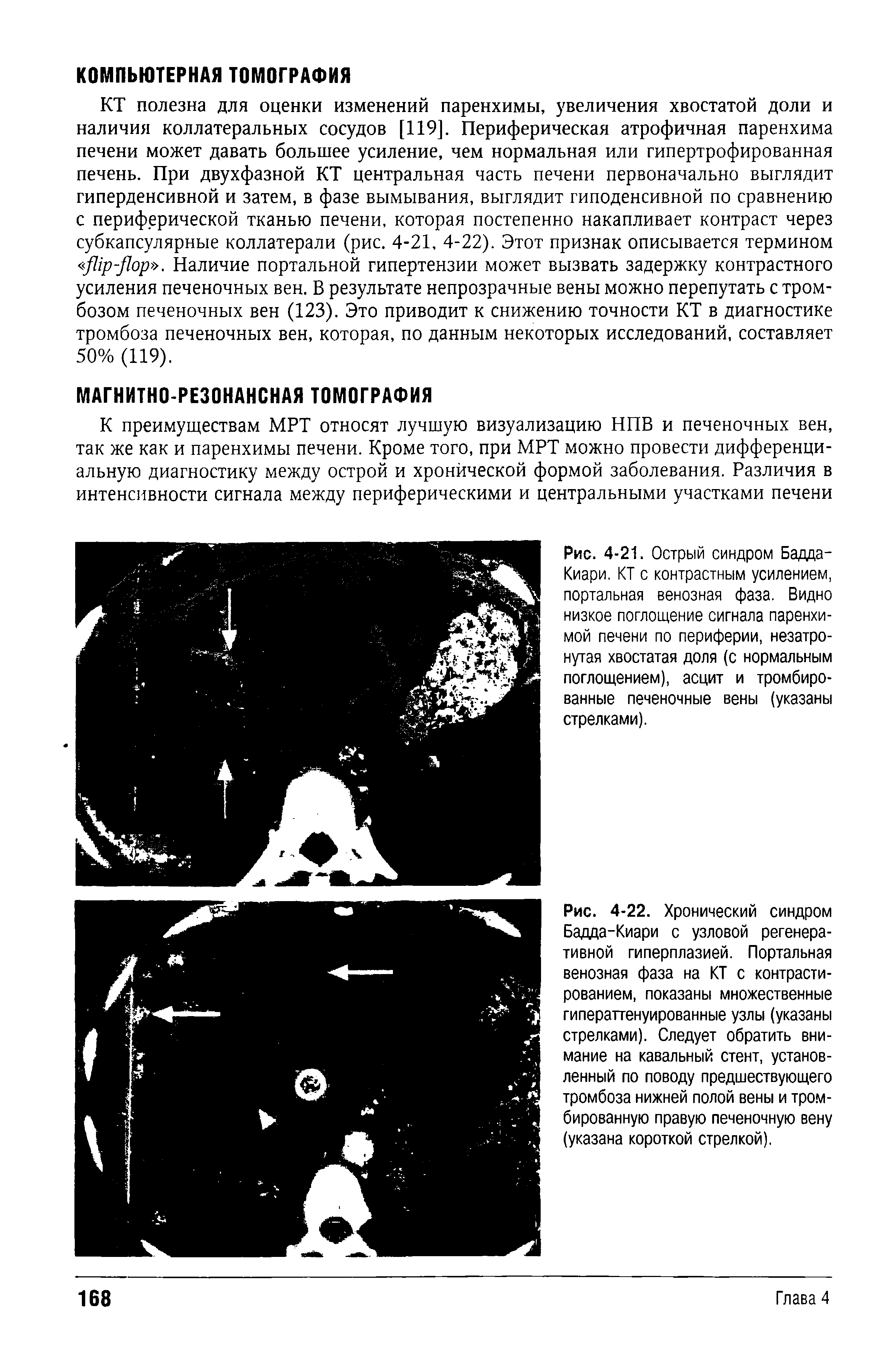 Рис. 4-21. Острый синдром Бадда-Киари. КТ с контрастным усилением, портальная венозная фаза. Видно низкое поглощение сигнала паренхимой печени по периферии, незатронутая хвостатая доля (с нормальным поглощением), асцит и тромбированные печеночные вены (указаны стрелками).