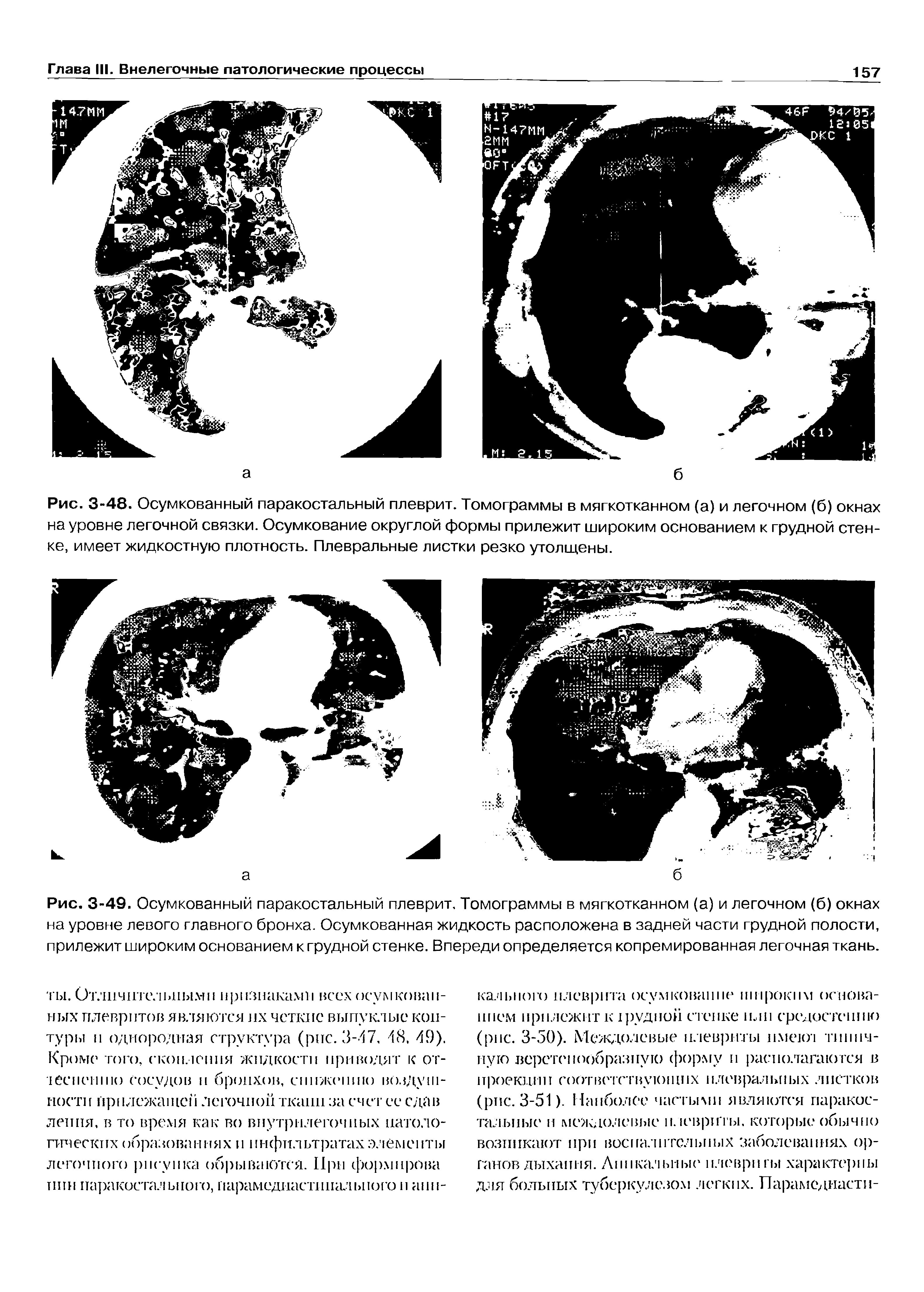 Рис. 3-48. Осумкованный паракостальный плеврит. Томограммы в мягкотканном (а) и легочном (б) окнах на уровне легочной связки. Осумкование округлой формы прилежит широким основанием к грудной стенке, имеет жидкостную плотность. Плевральные листки резко утолщены.