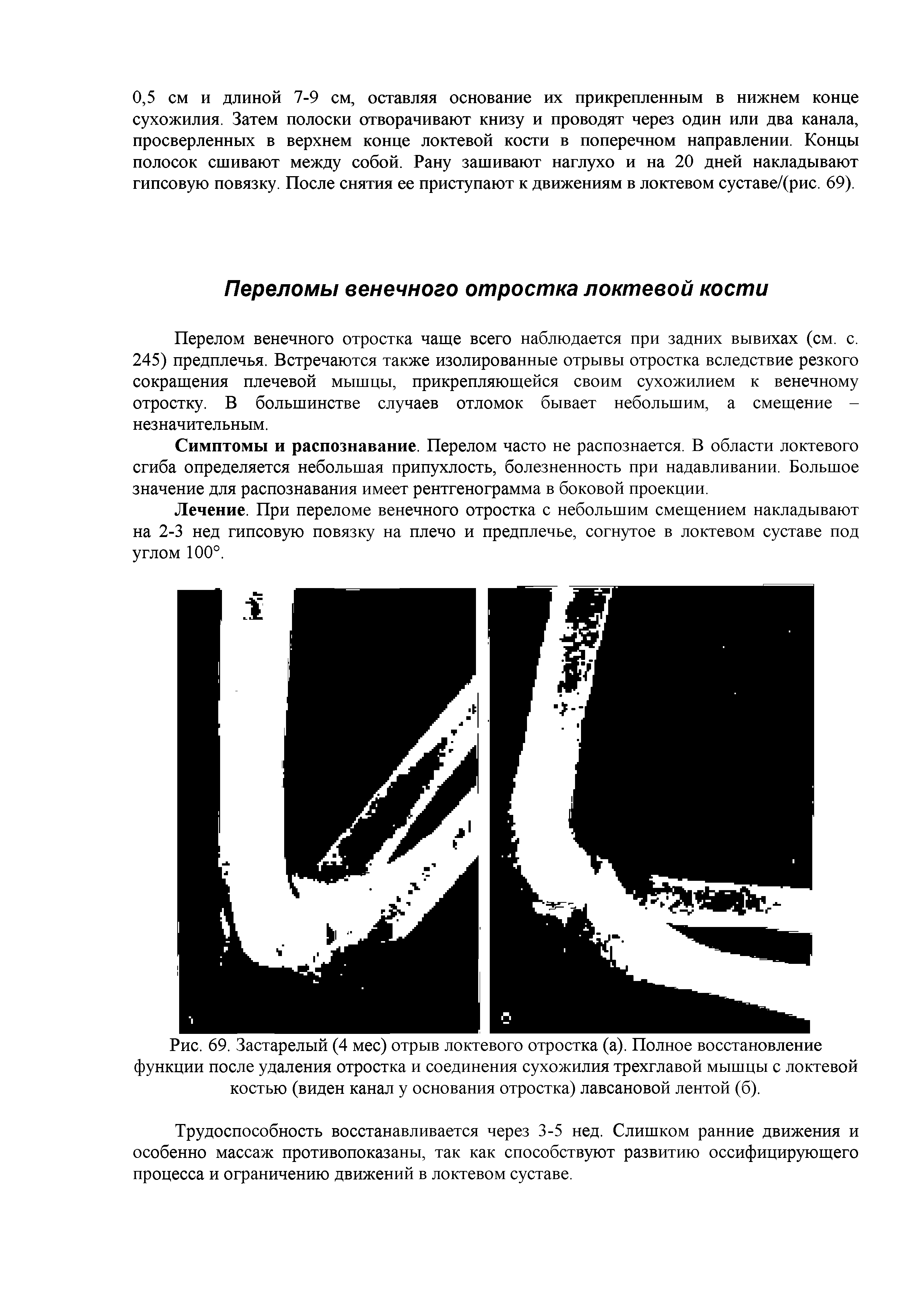 Рис. 69. Застарелый (4 мес) отрыв локтевого отростка (а). Полное восстановление функции после удаления отростка и соединения сухожилия трехглавой мышцы с локтевой костью (виден канал у основания отростка) лавсановой лентой (б).