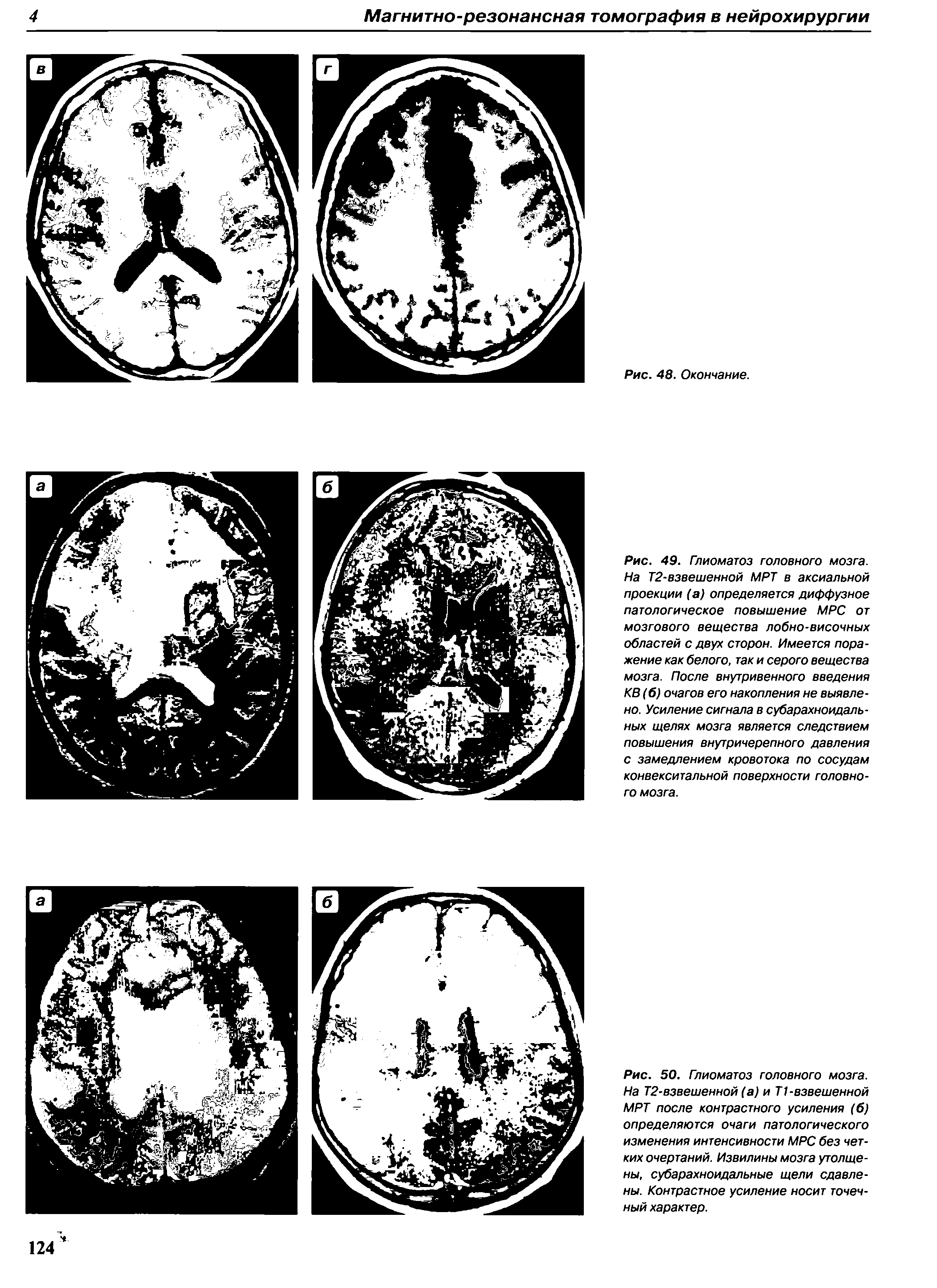 Рис. 50. Глиоматоз головного мозга. На Т2-взвешенной (а) и Т1 -взвешенной МРТ после контрастного усиления (б) определяются очаги патологического изменения интенсивности MPC без четких очертаний. Извилины мозга утолщены, субарахноидальные щели сдавлены. Контрастное усиление носит точечный характер.