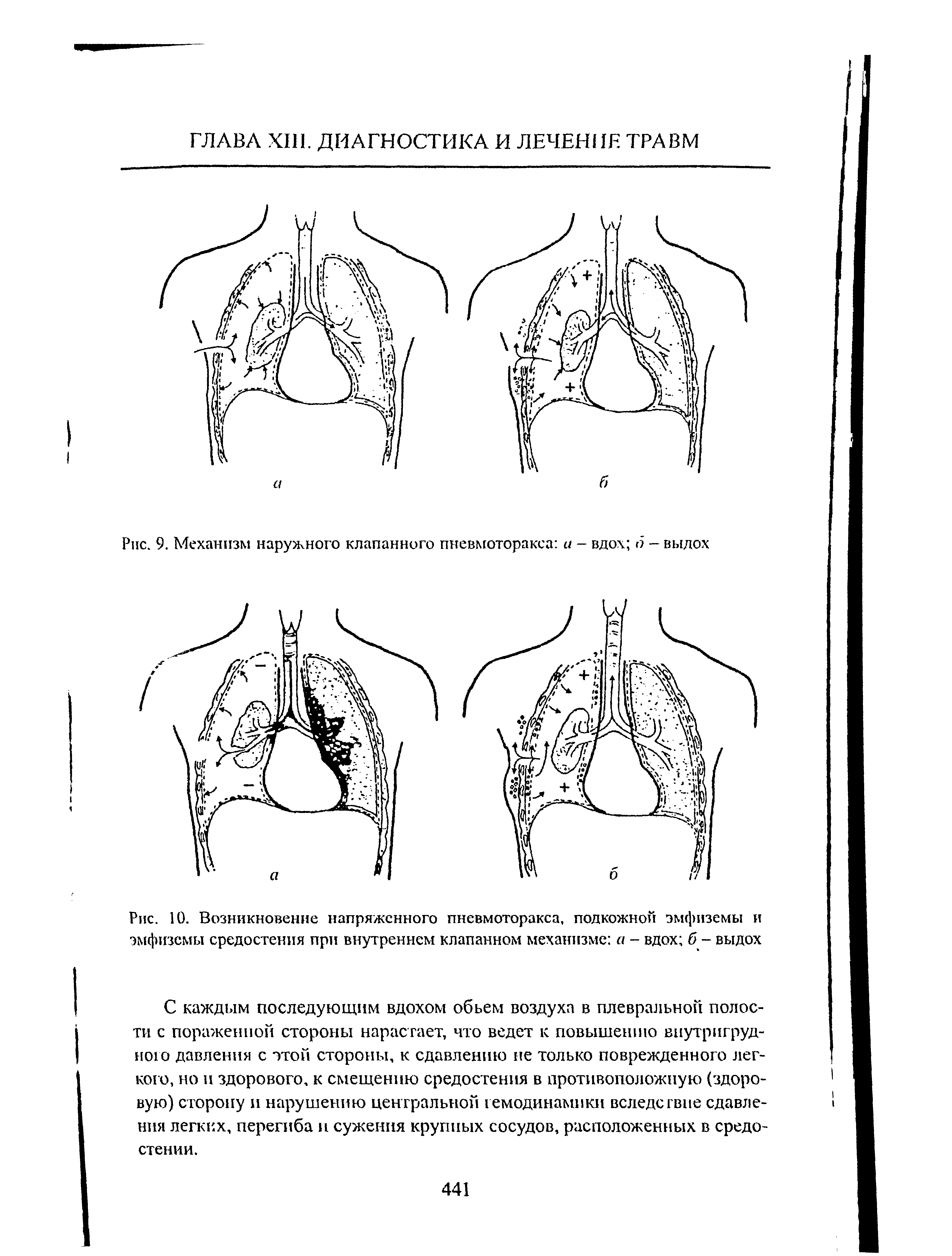 Рис. 10. Возникновение напряженного пневмоторакса, подкожной эмфиземы и эмфиземы средостения при внутреннем клапанном механизме а - вдох б - выдох...