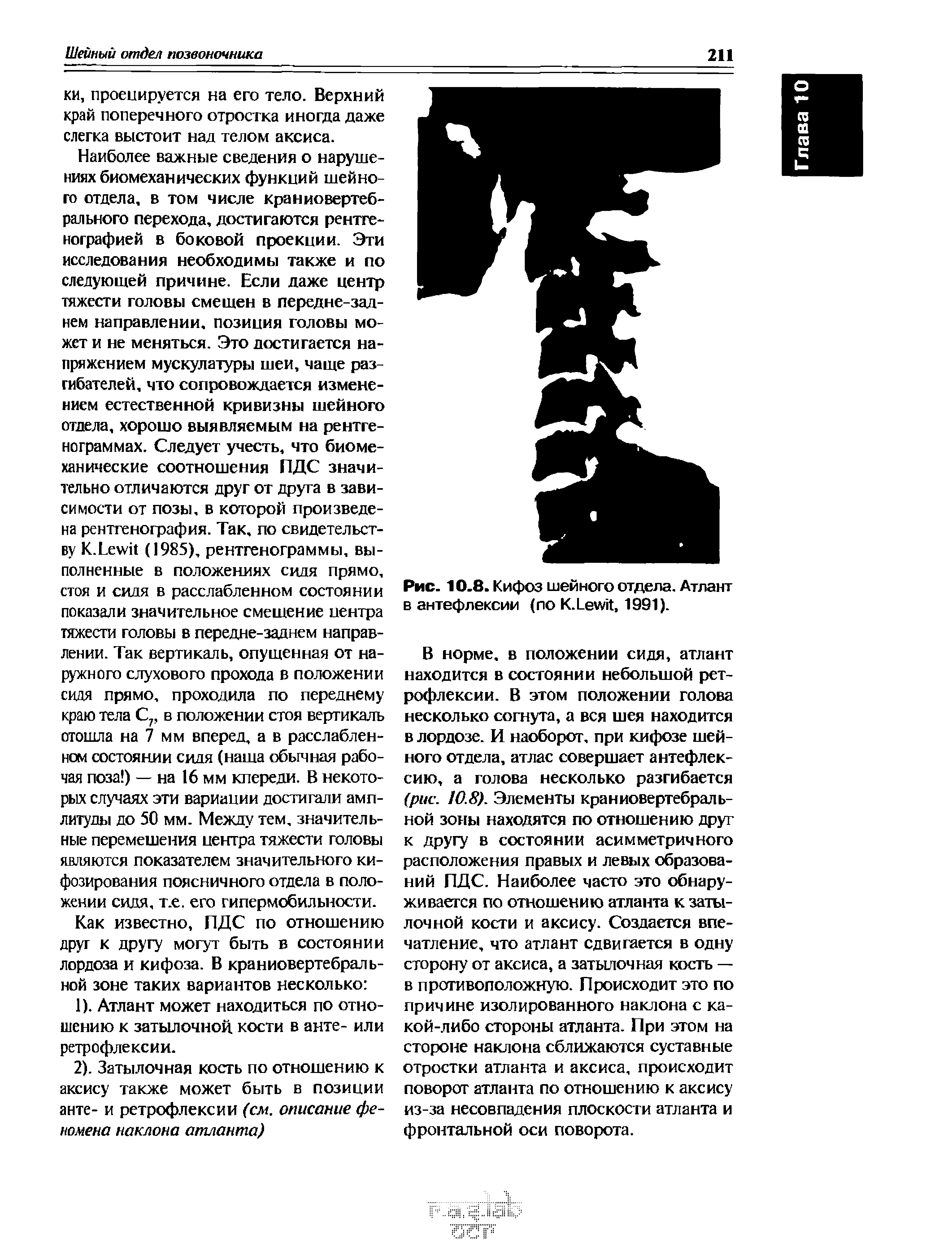 Рис. 10.8. Кифоз шейного отдела. Атлант в антефлексии (по К.ЬеиуИ, 1991).