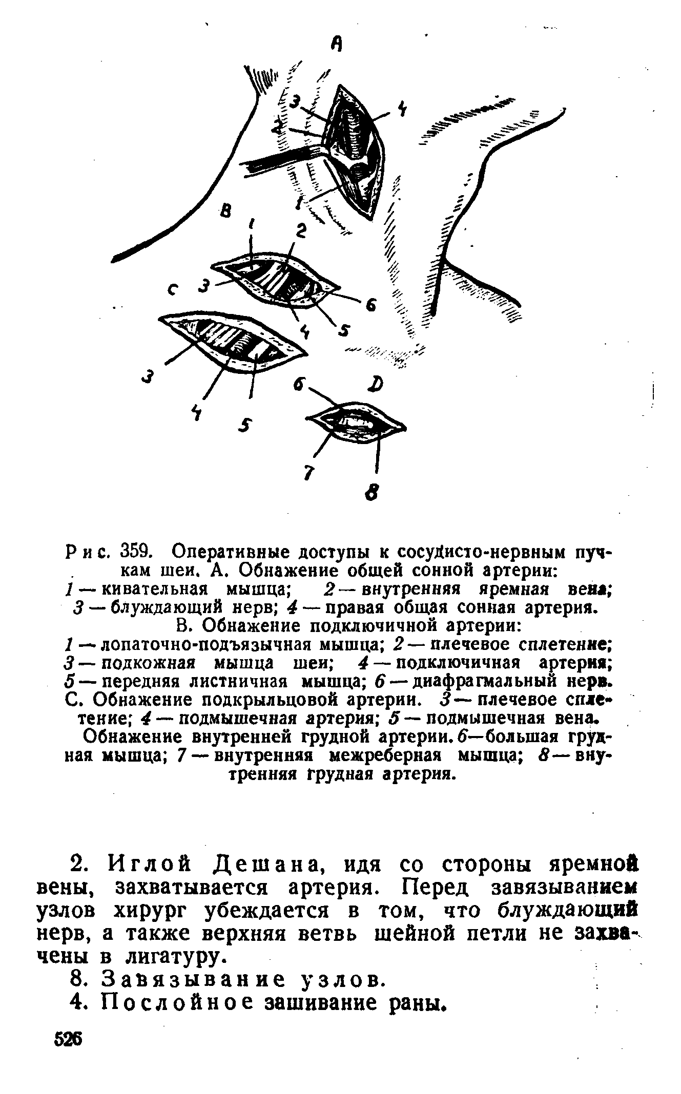 Рис. 359. Оперативные доступы к сосуйисто-нервным пучкам шеи. А. Обнажение общей сонной артерии ...