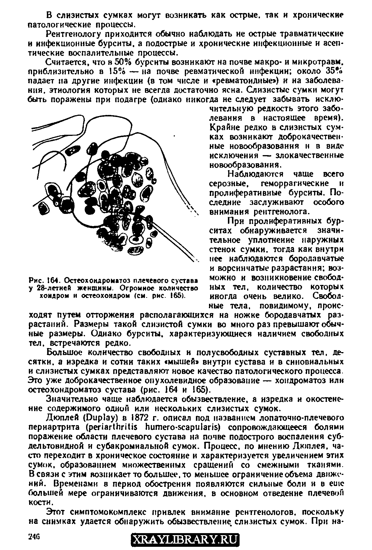 Рис. 164. Остеохондроматоз плечевого сустава у 28-летней женщины. Огромное количество хондром и остеохондром (см. рис. 165).