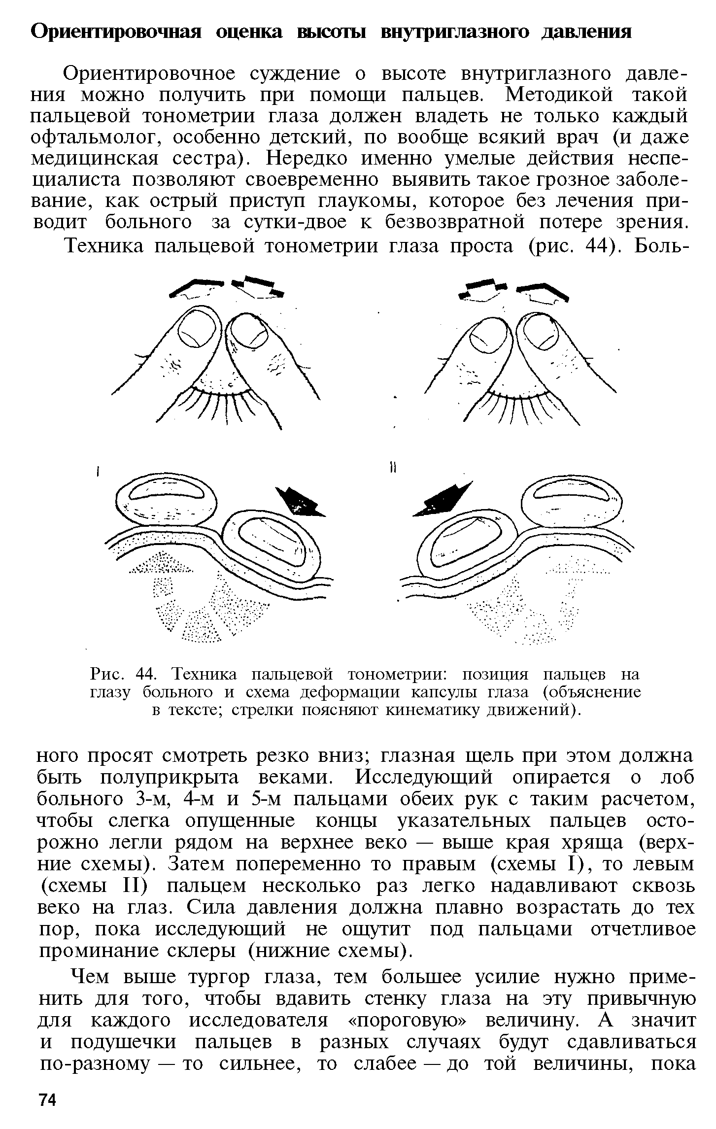 Рис. 44. Техника пальцевой тонометрии позиция пальцев на глазу больного и схема деформации капсулы глаза (объяснение в тексте стрелки поясняют кинематику движений).