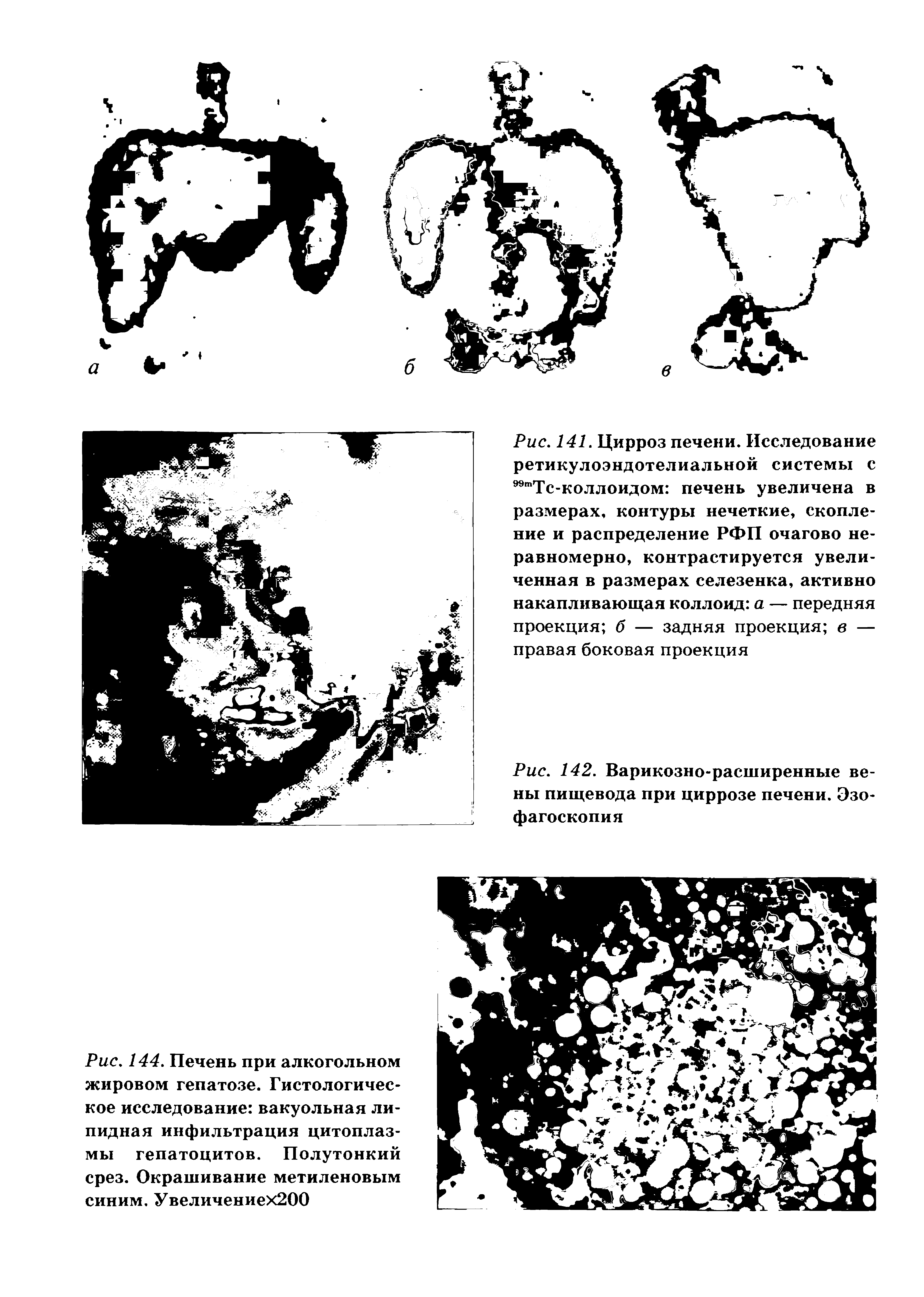 Рис. 144. Печень при алкогольном жировом гепатозе. Гистологическое исследование вакуольная липидная инфильтрация цитоплазмы гепатоцитов. Полутонкий срез. Окрашивание метиленовым синим. Увеличениех200...