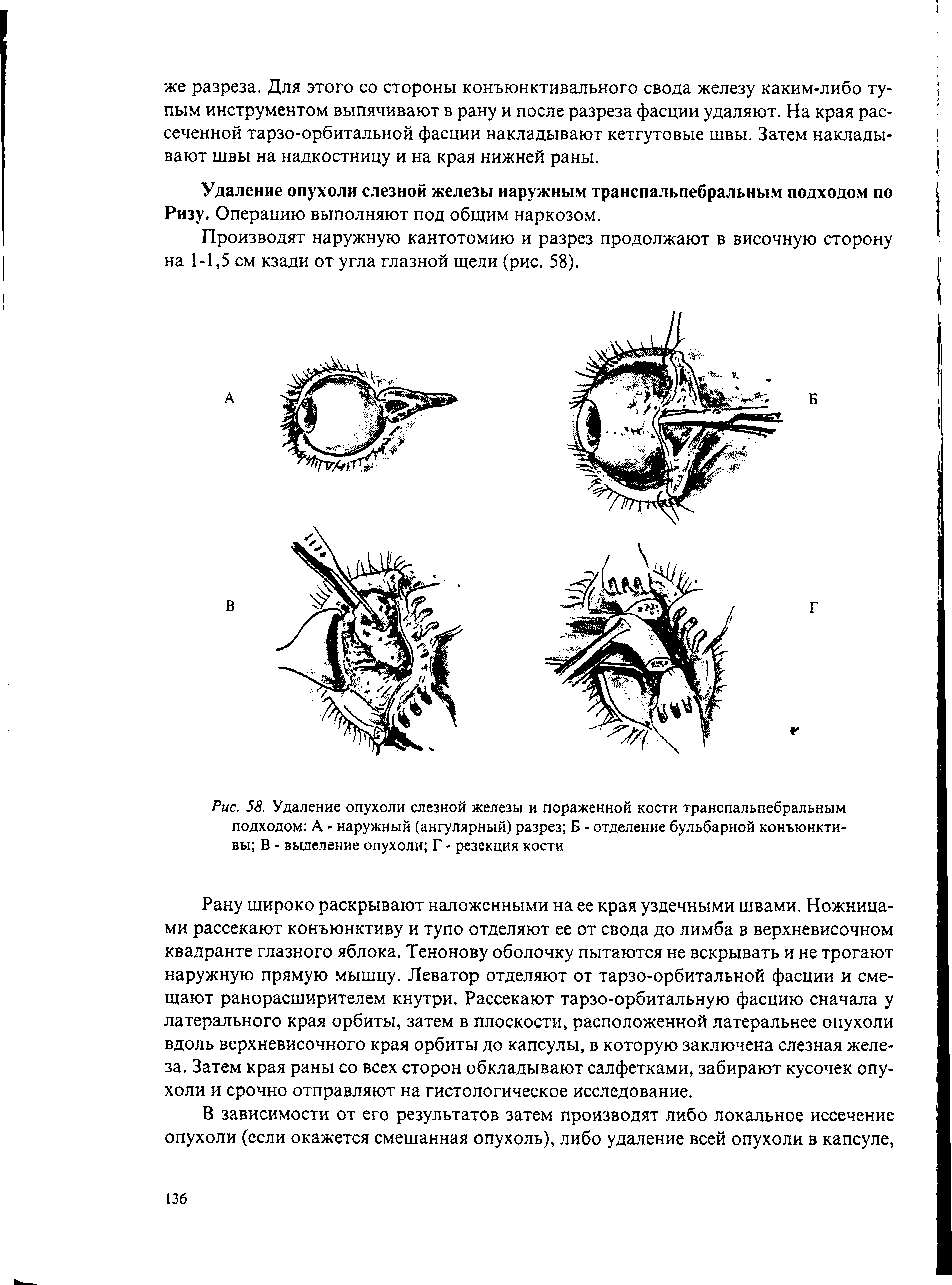 Рис. 58. Удаление опухоли слезной железы и пораженной кости транспальпебральным подходом А - наружный (ангулярный) разрез Б - отделение бульбарной конъюнктивы В - выделение опухоли Г - резекция кости...
