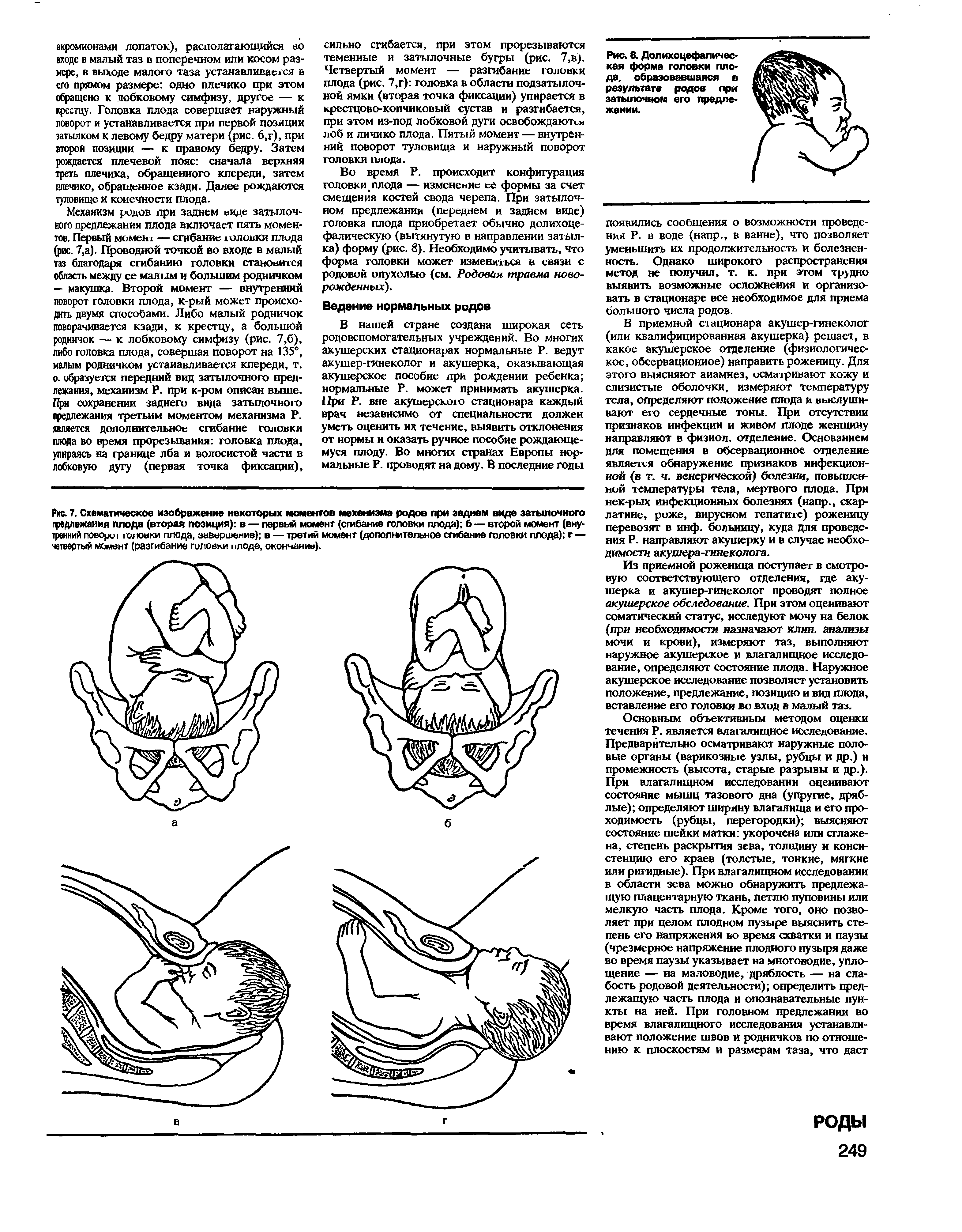 Рис. 7. Схематическое изображение некоторых моментов мехенизма родов при заднем виде затылочного предлежания плода (вторая позиция) в — первый момент (сгибание головки плода) б — второй момент (внутренний повори головки плода, завершение) в — третий момент (дополнительное сгибание головки плода) г — четвертый момент (разгибание головки шоде, окончание).