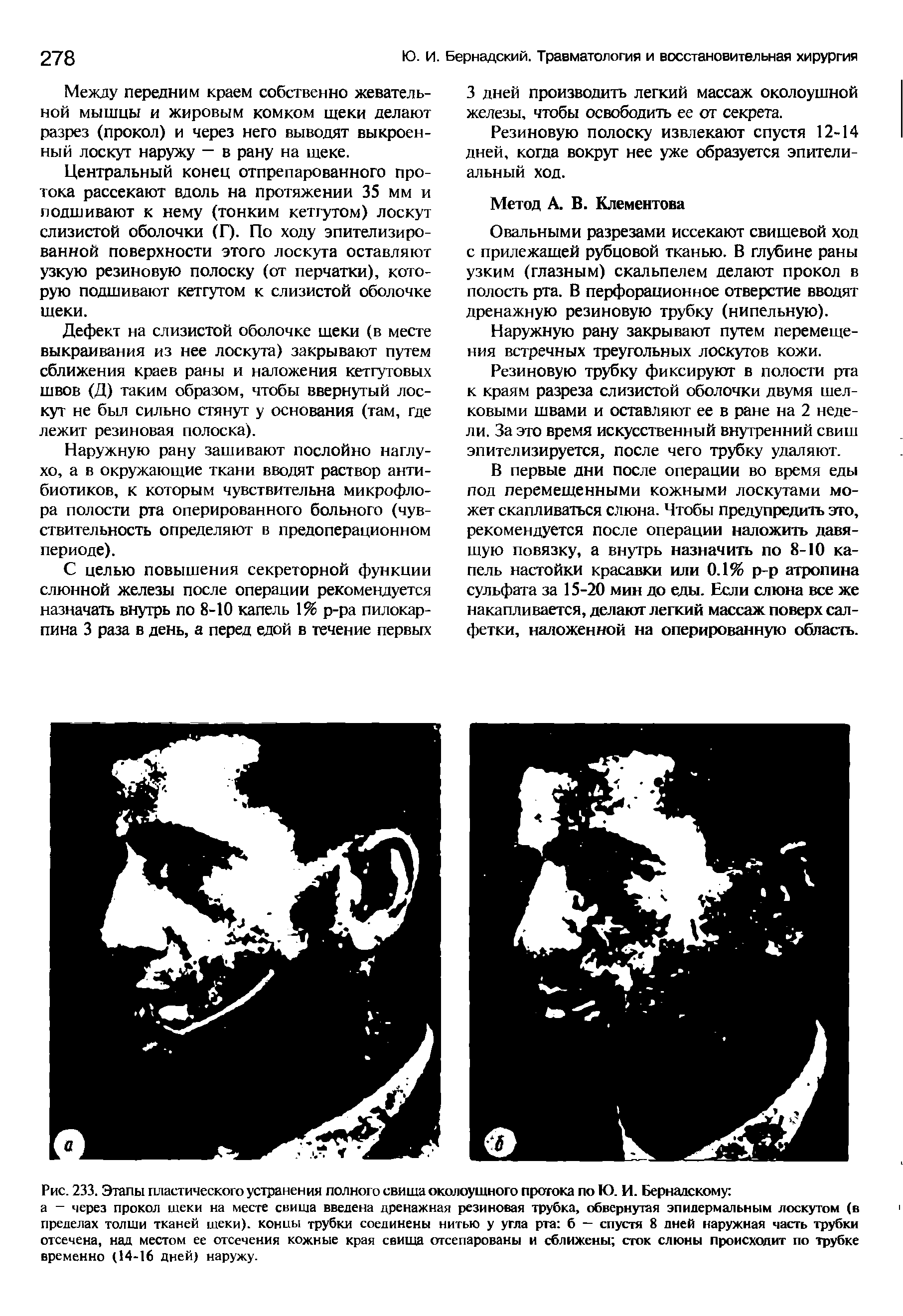 Рис. 233. Этапы пластического устранения полного свища околоушного протока по Ю. И. Вернадскому ...