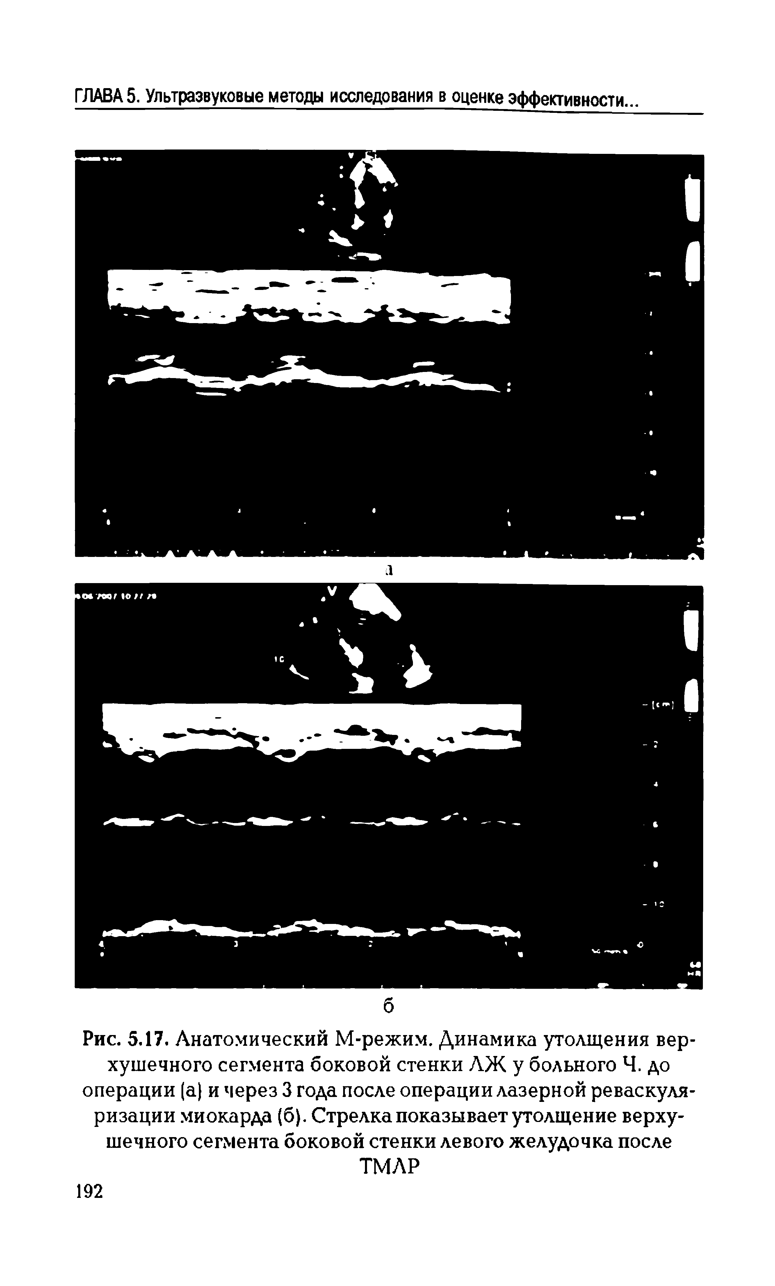 Рис. 5.17. Анатомический М-режим. Динамика утолщения верхушечного сегмента боковой стенки АЖ у больного Ч. до операции (а) и через 3 года после операции лазерной реваскуляризации миокарда (б). Стрелка показывает утолщение верхушечного сегмента боковой стенки левого желудочка после ТМАР...