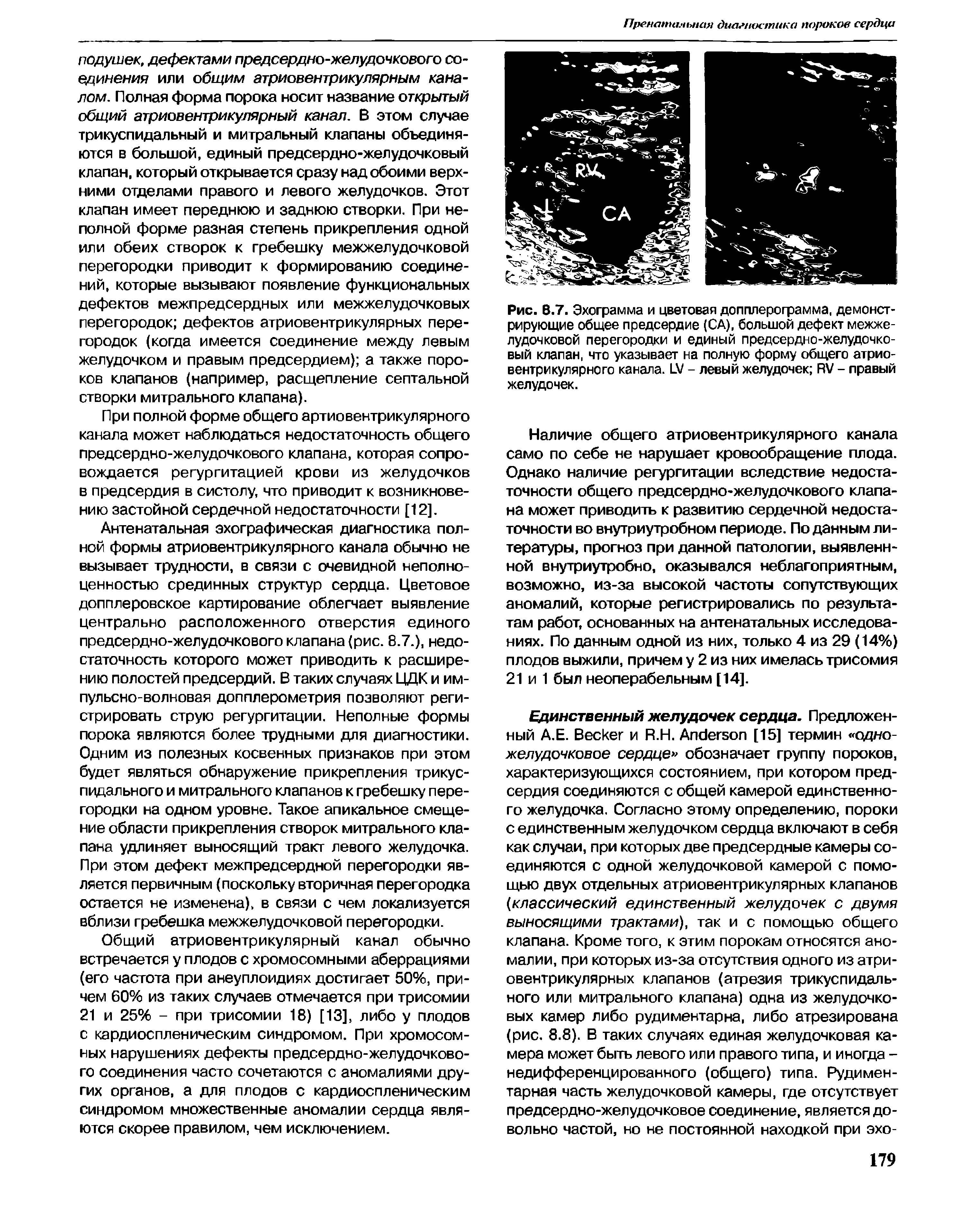 Рис. В.7. Эхограмма и цветовая допплерограмма, демонстрирующие общее предсердие (СА), большой дефект межжелудочковой перегородки и единый предсердно-желудочковый клапан, что указывает на полную форму общего атриовентрикулярного канала. LV - левый желудочек RV - правый желудочек.