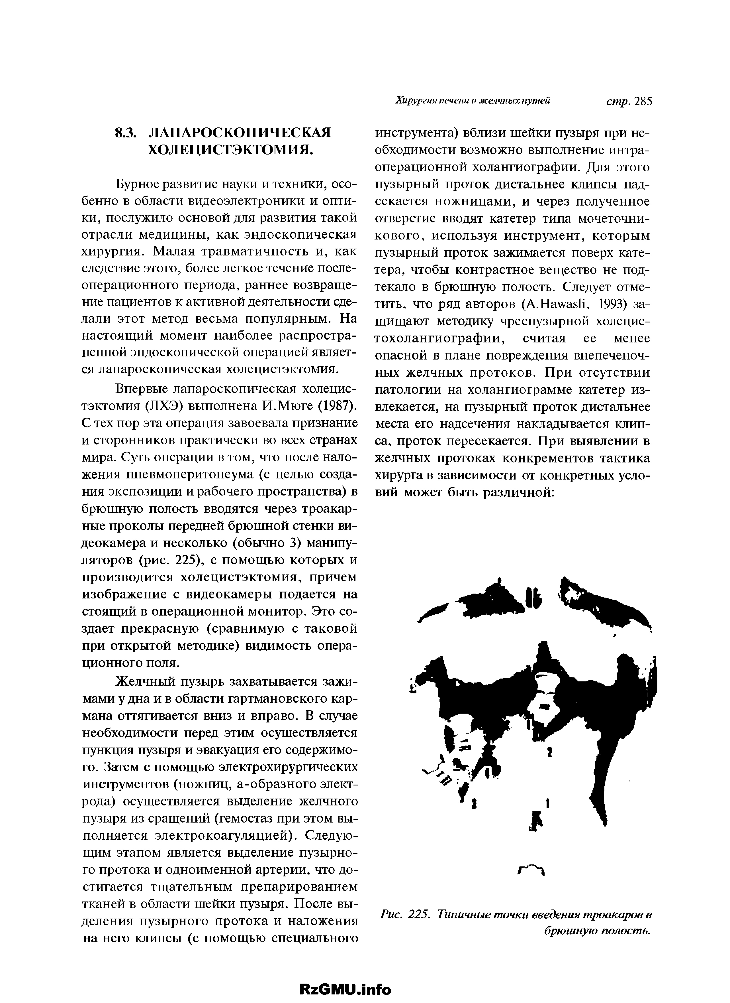 Рис. 225. Типичные точки введения троакаров в брюшную полость.