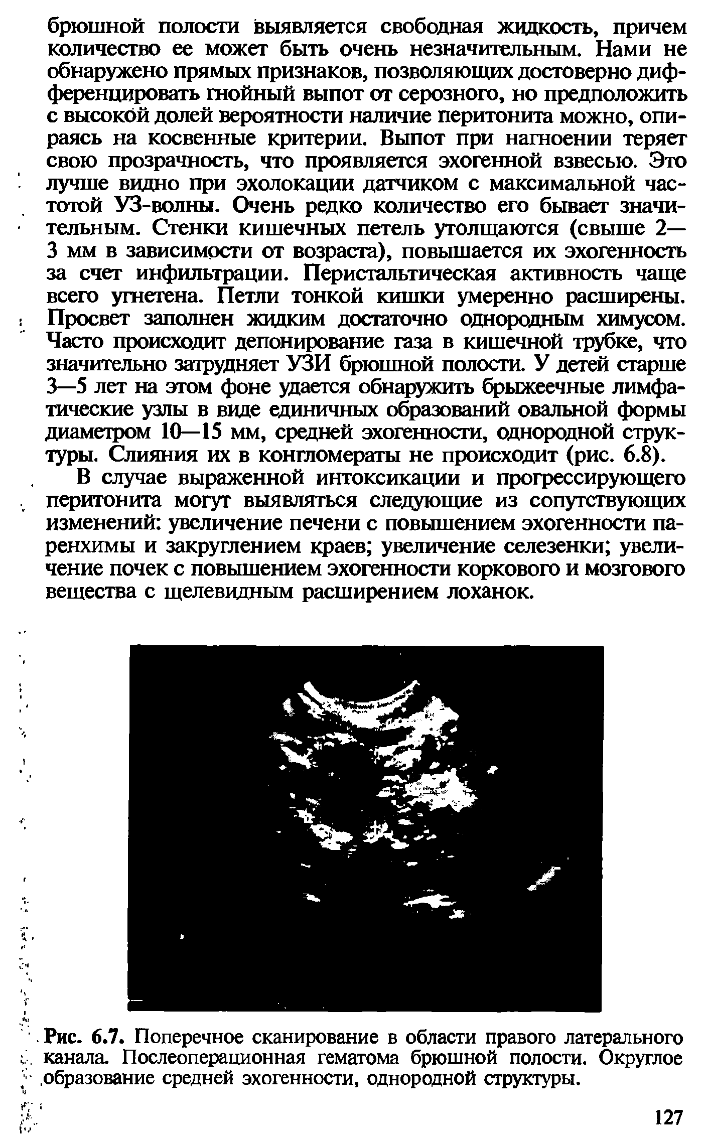 Рис. 6.7. Поперечное сканирование в области правого латерального канала. Послеоперационная гематома брюшной полости. Округлое . образование средней эхогенности, однородной структуры.