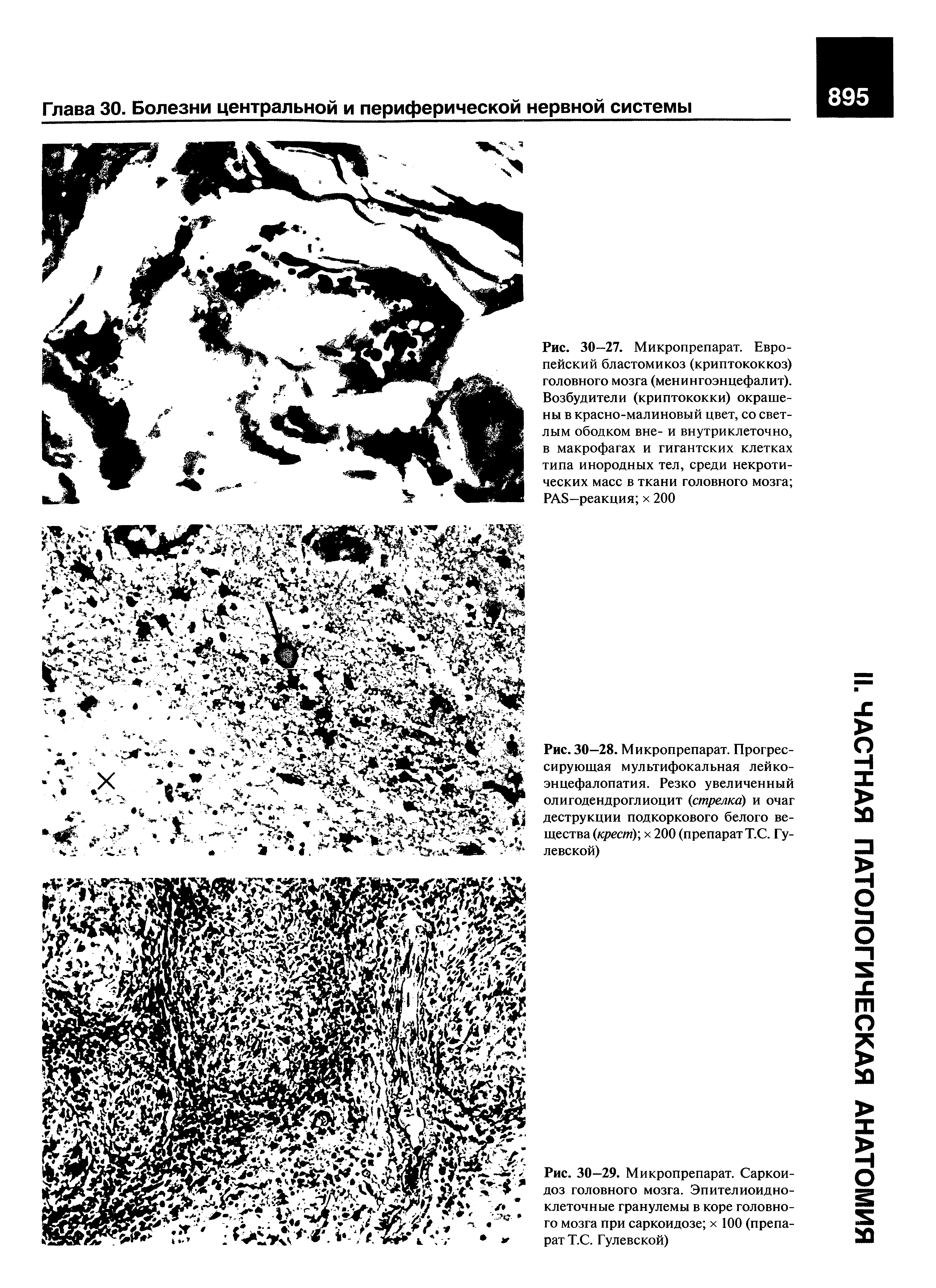 Рис. 30—27. Микропрепарат. Европейский бластомикоз (криптококкоз) головного мозга (менингоэнцефалит). Возбудители (криптококки) окрашены в красно-малиновый цвет, со светлым ободком вне- и внутриклеточно, в макрофагах и гигантских клетках типа инородных тел, среди некротических масс в ткани головного мозга PAS—реакция х 200...