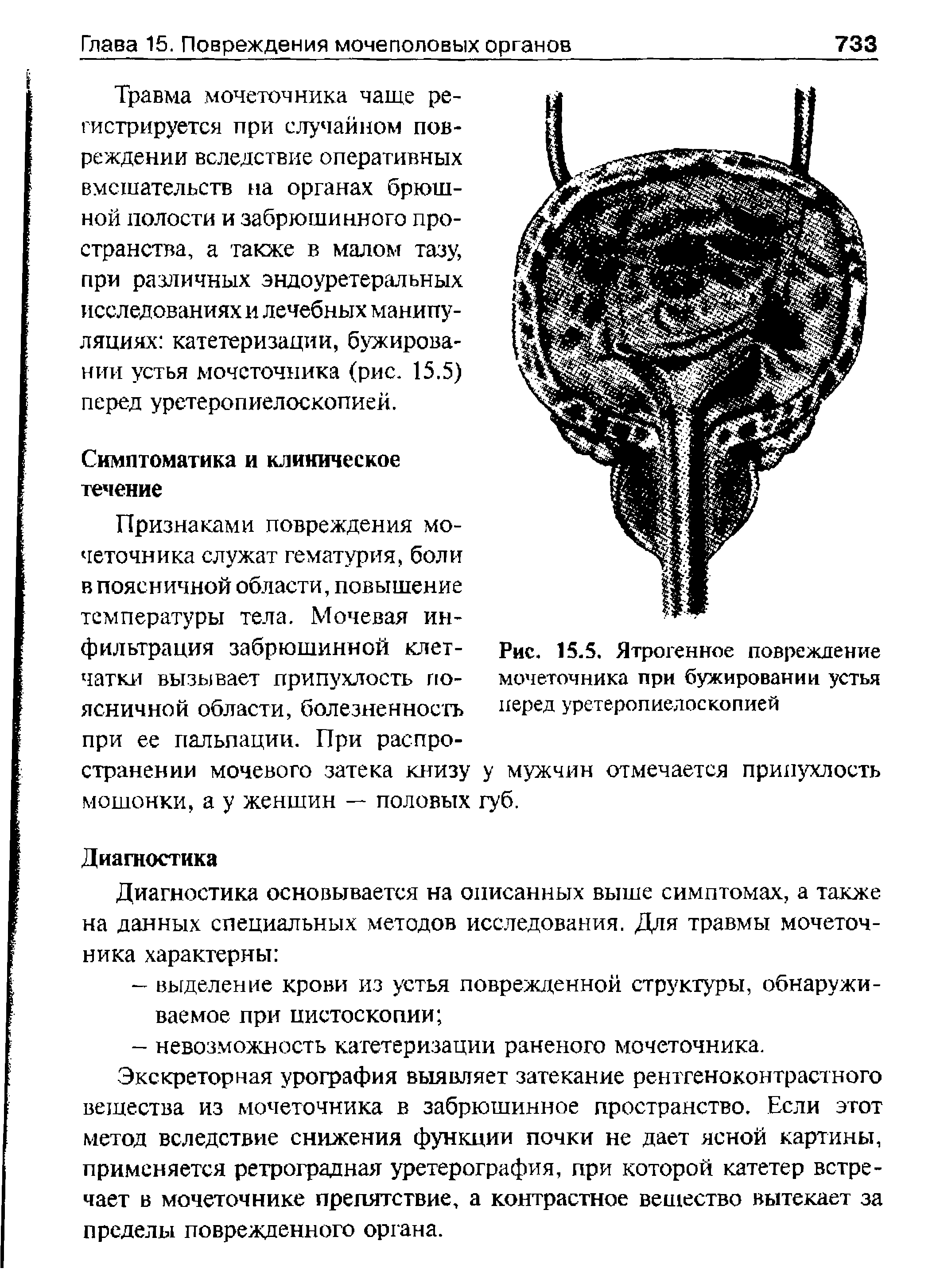 Рис. 15.5. Ятрогенное повреждение мочеточника при бужировании устья перед уретеропиелоскопией...