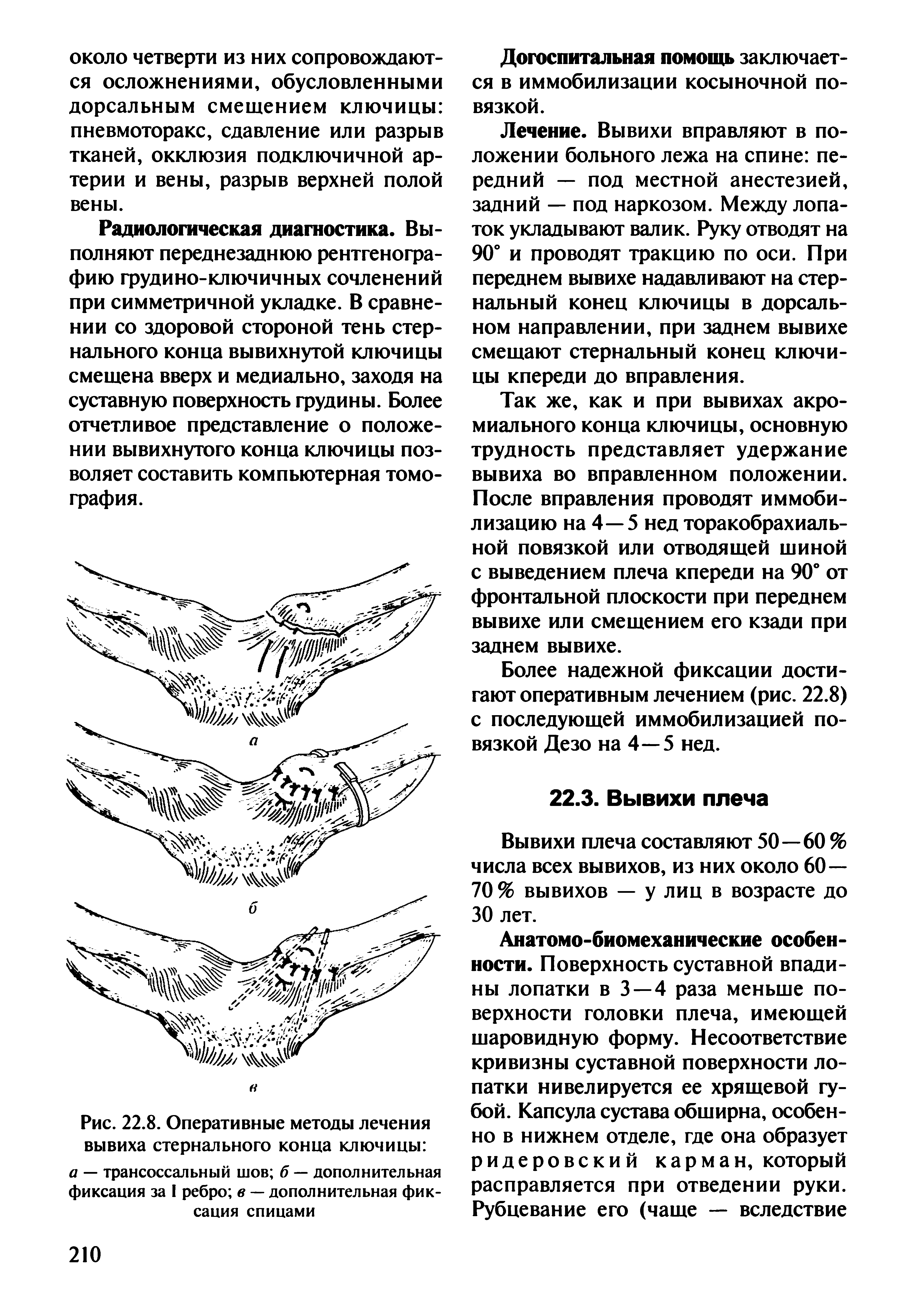 Рис. 22.8. Оперативные методы лечения вывиха стернального конца ключицы а — трансоссальный шов б — дополнительная фиксация за I ребро в — дополнительная фиксация спицами...